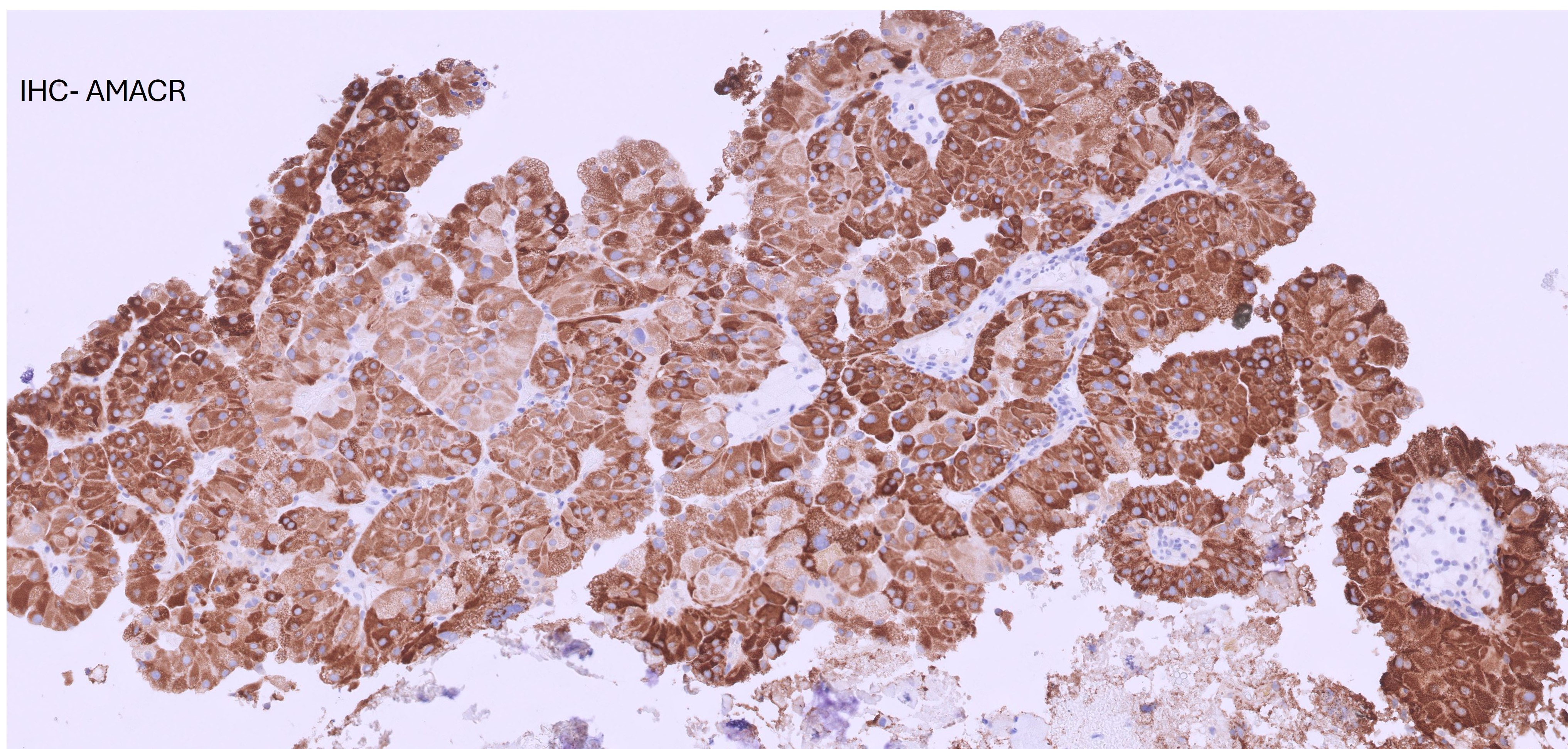 Microscopic image possibly detecting cancerous areas in human tissue