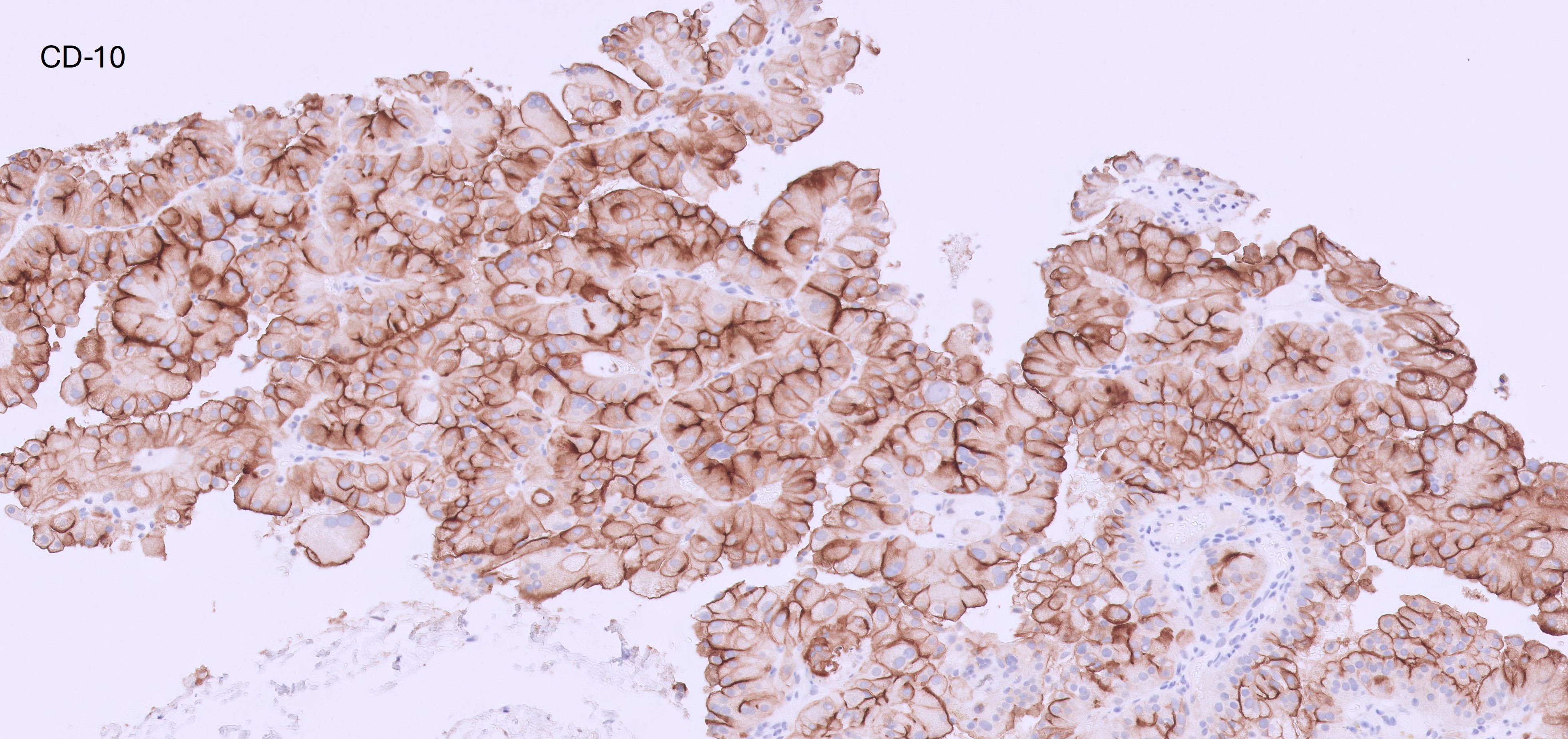 Microscopic image possibly detecting cancerous areas in human tissue