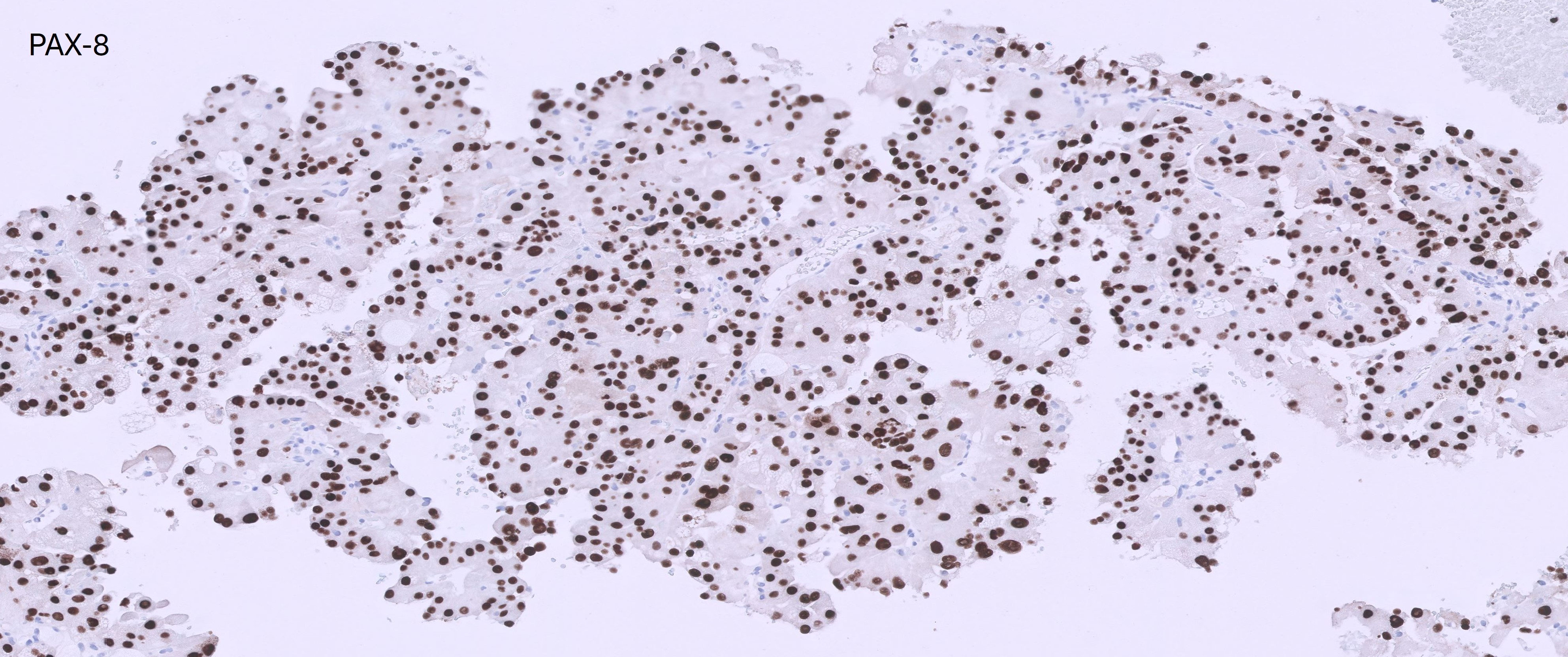 Microscopic image possibly detecting cancerous areas in human tissue