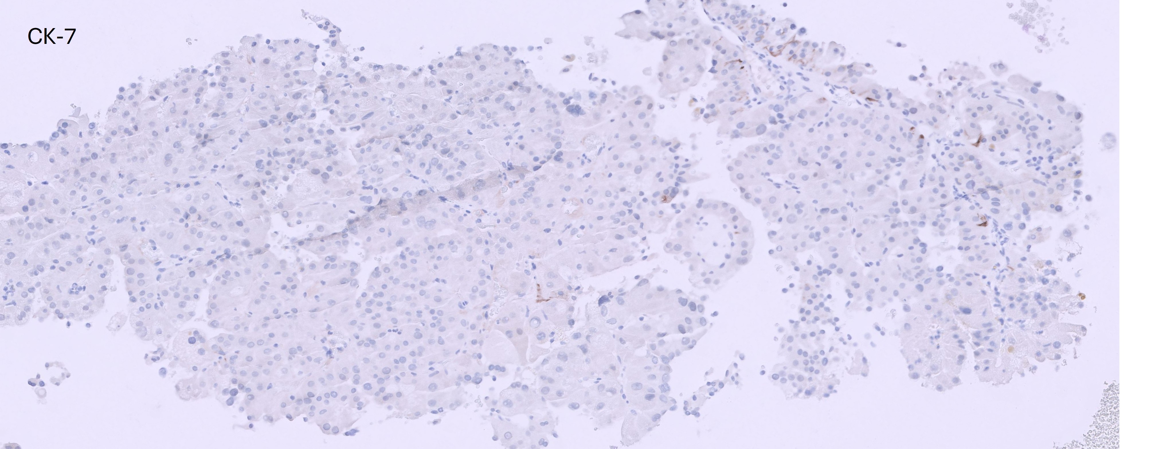 Microscopic image possibly detecting cancerous areas in human tissue