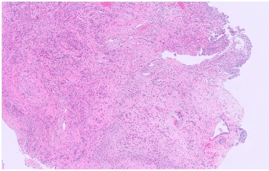 Microscopic image possibly detecting cancerous areas in human tissue