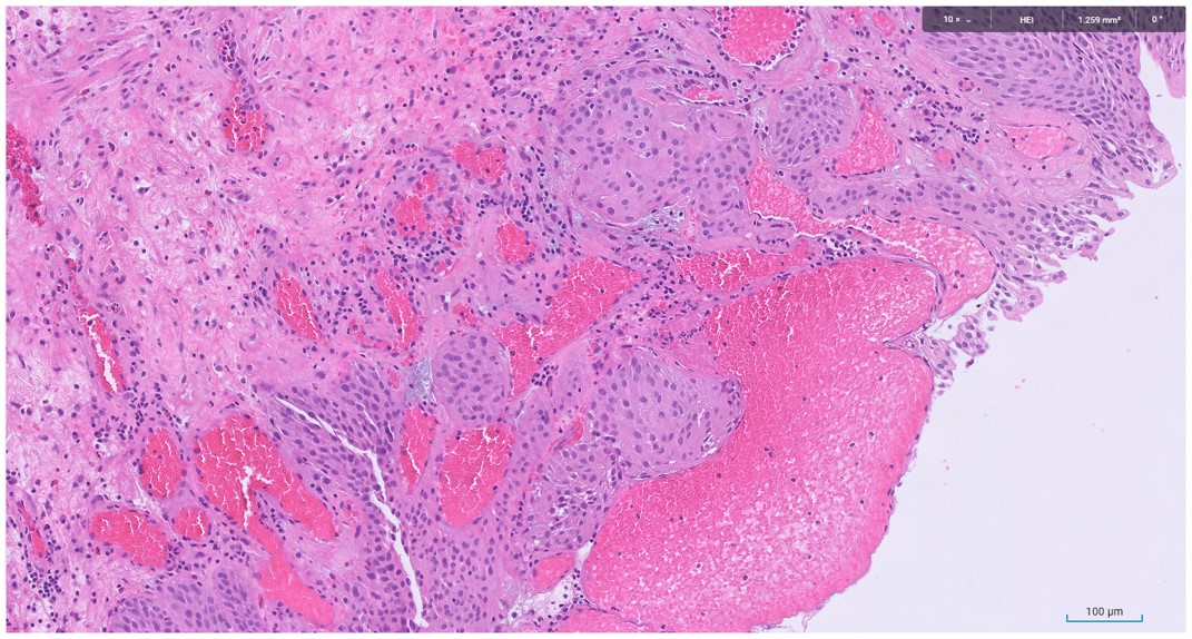 Microscopic image possibly detecting cancerous areas in human tissue