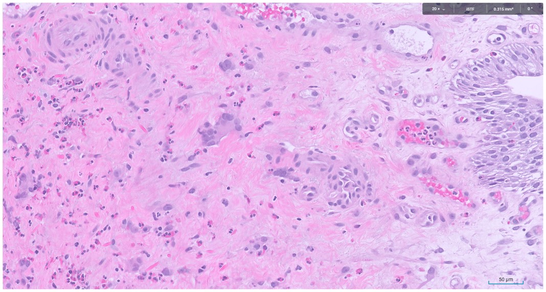 Microscopic image possibly detecting cancerous areas in human tissue