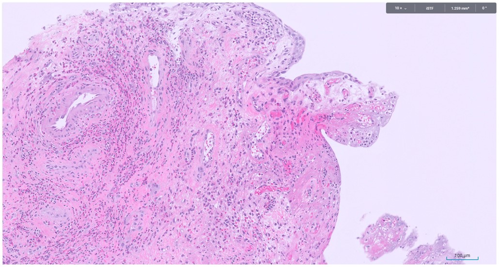 Microscopic image possibly detecting cancerous areas in human tissue