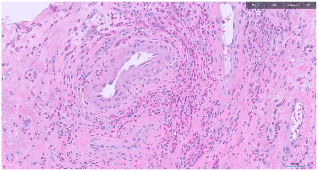Microscopic image possibly detecting cancerous areas in human tissue