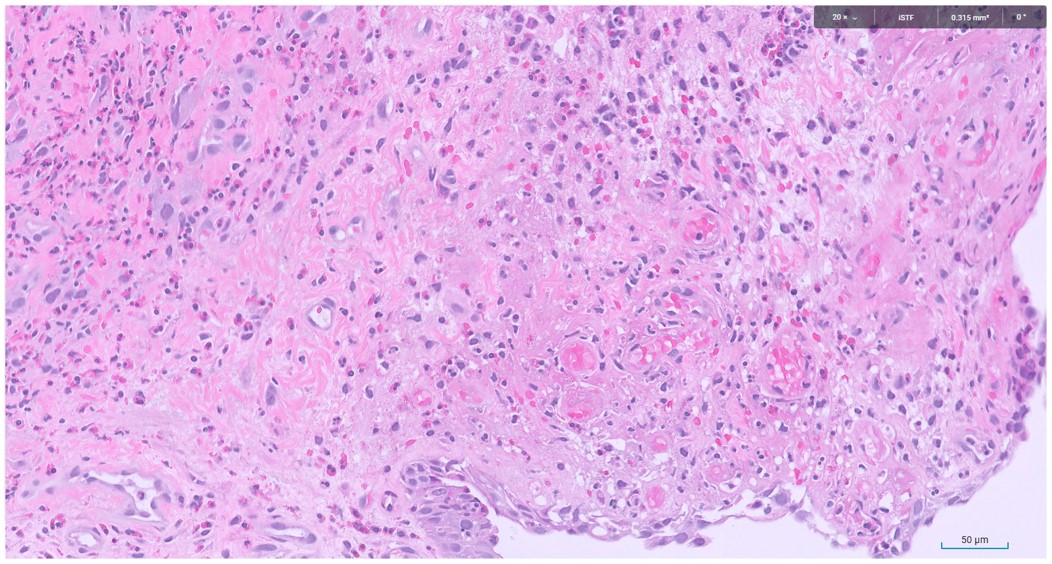 Microscopic image possibly detecting cancerous areas in human tissue