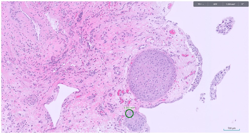 Microscopic image possibly detecting cancerous areas in human tissue