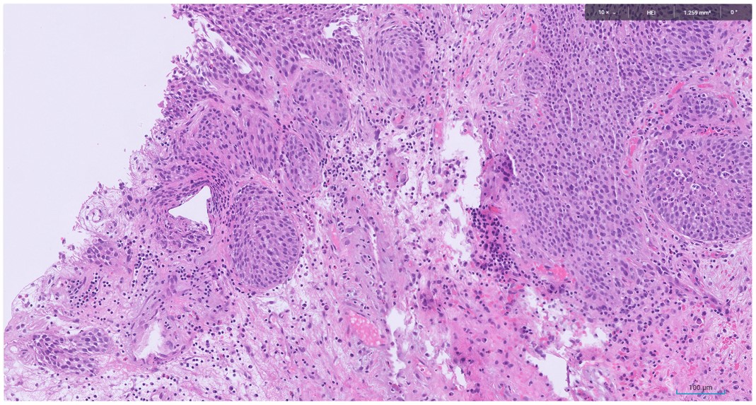 Microscopic image possibly detecting cancerous areas in human tissue