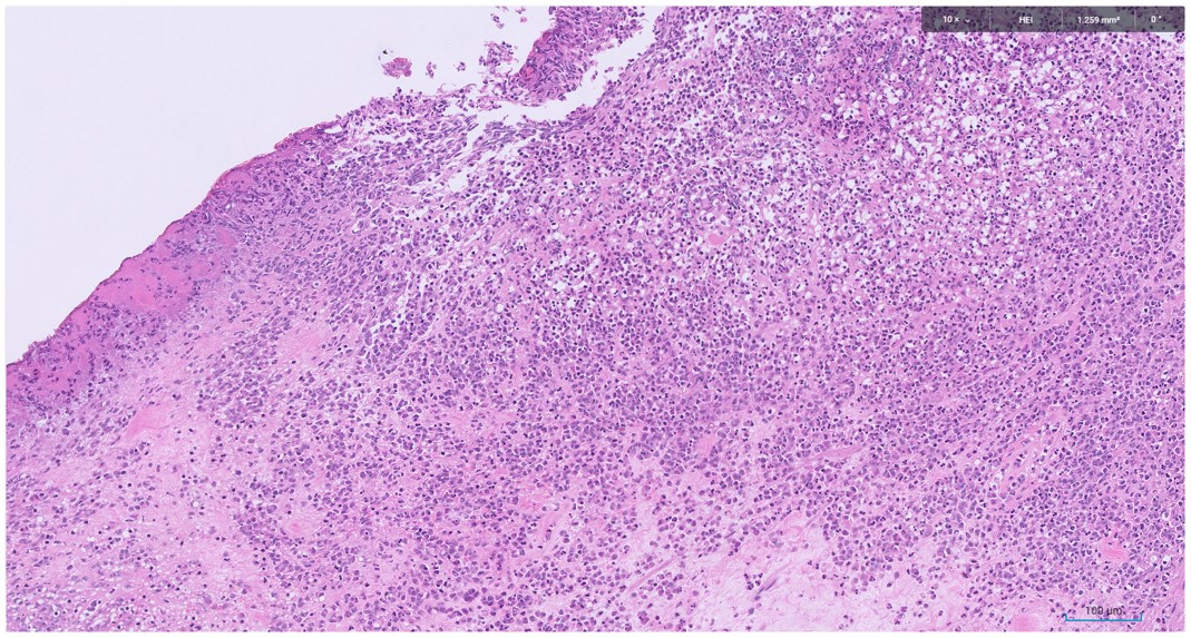 Microscopic image possibly detecting cancerous areas in human tissue