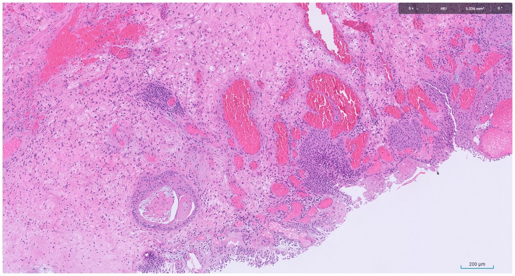 Microscopic image possibly detecting cancerous areas in human tissue