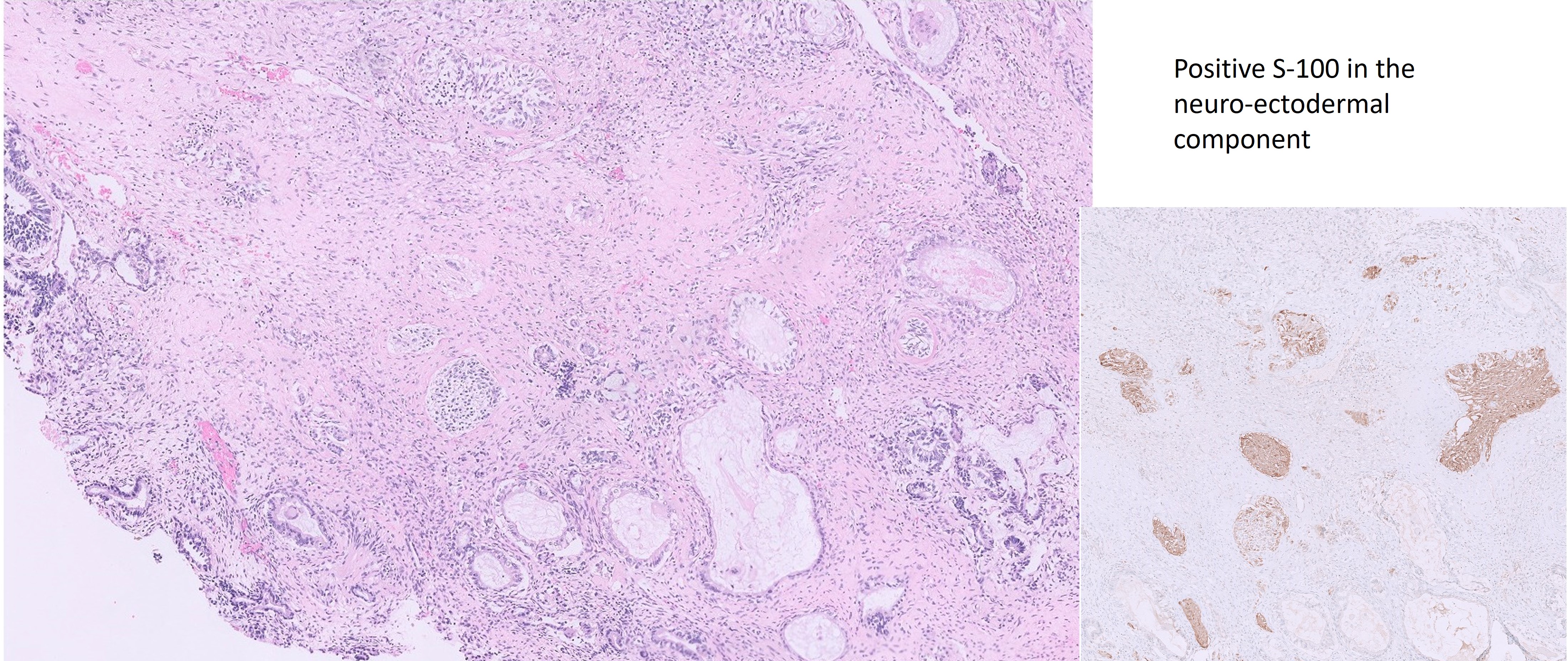 Microscopic image possibly detecting cancerous areas in human tissue