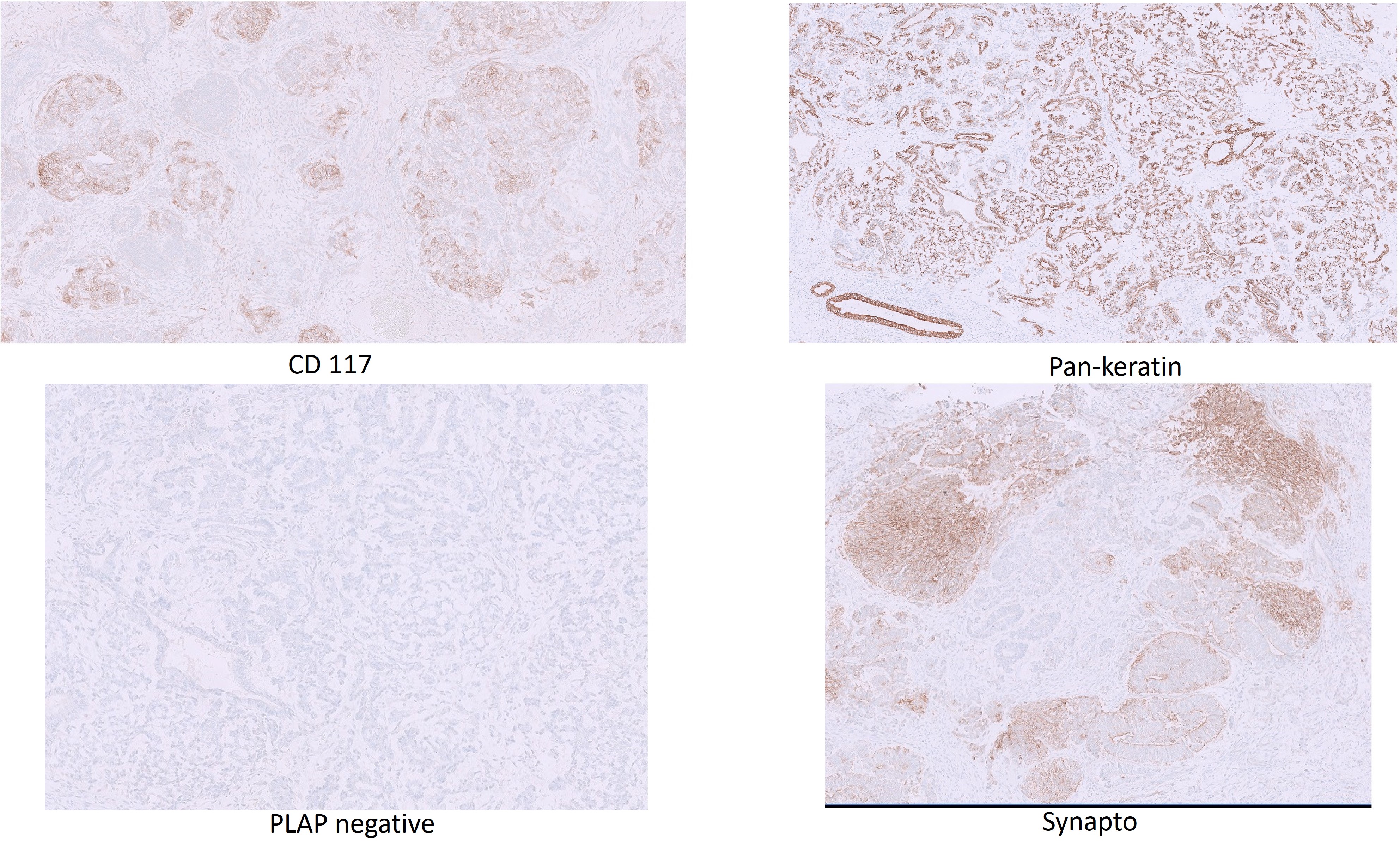 Microscopic image possibly detecting cancerous areas in human tissue