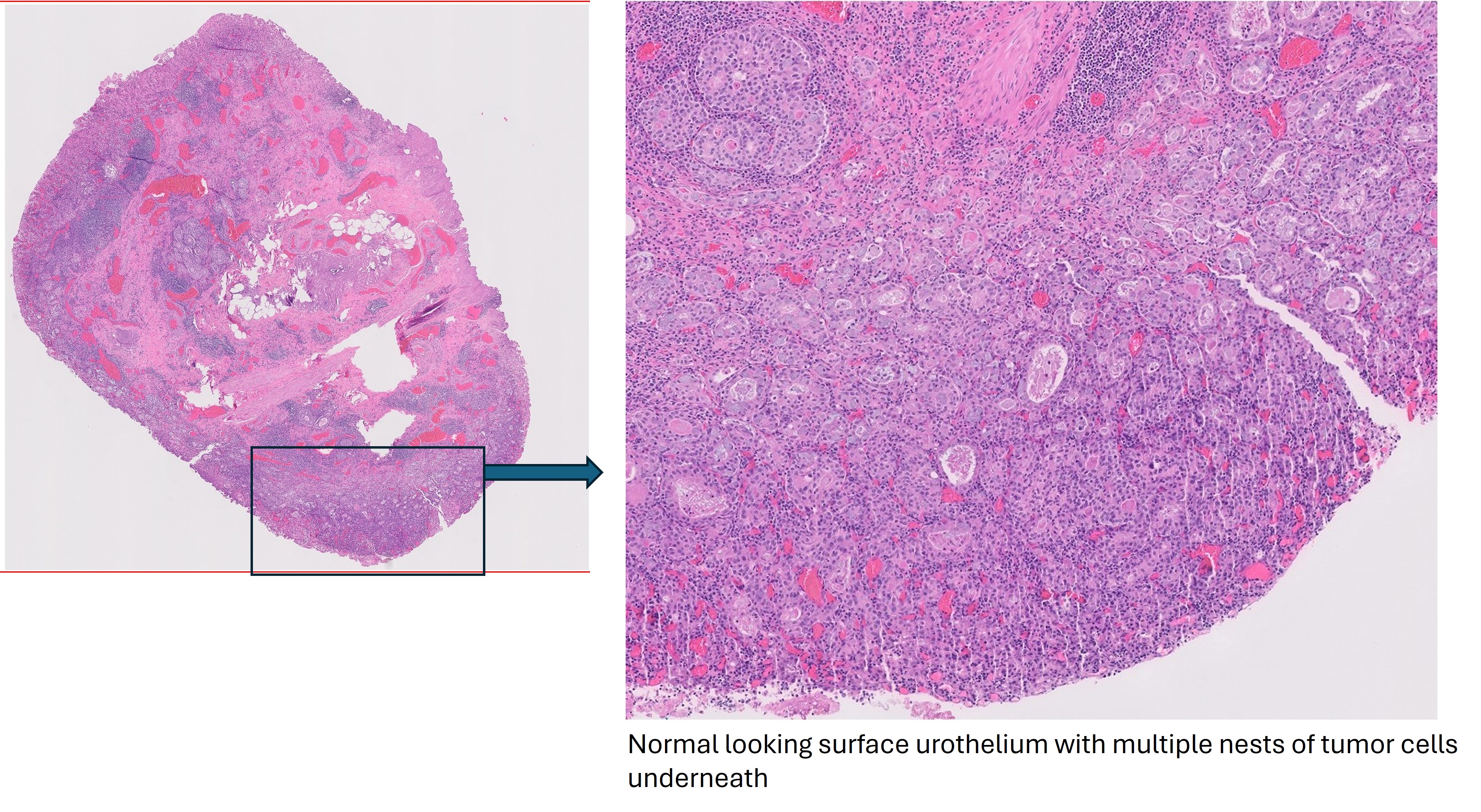 Microscopic image possibly detecting cancerous areas in human tissue