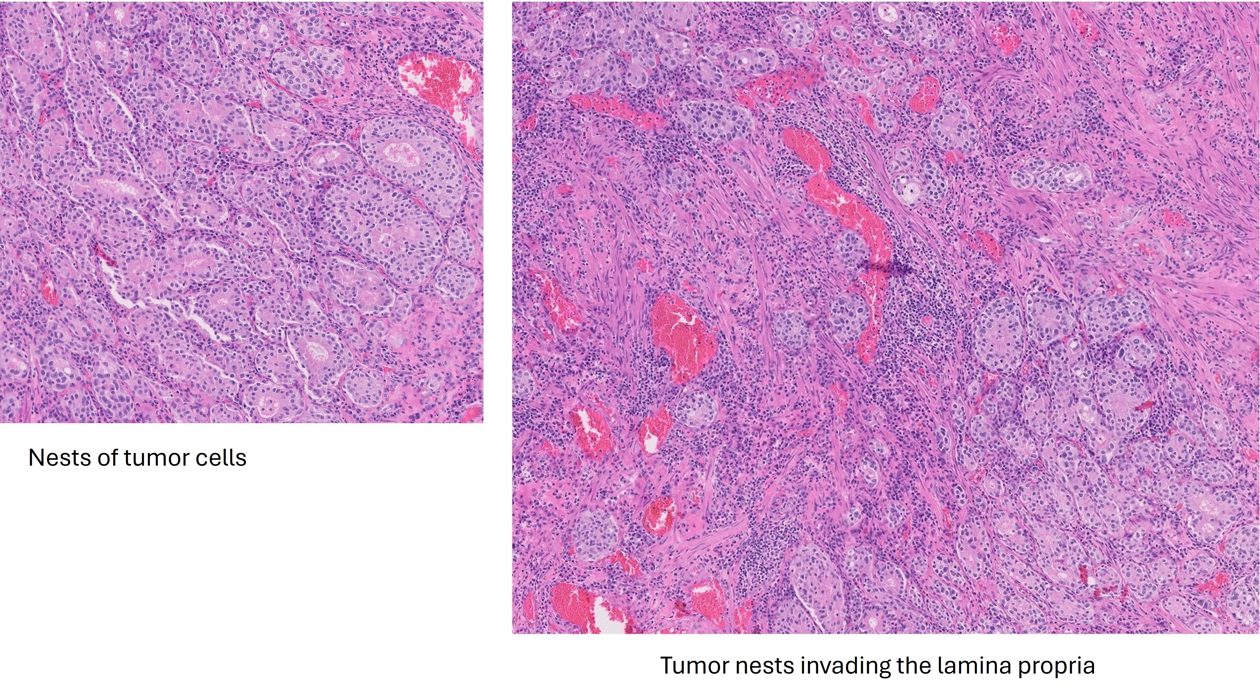 Microscopic image possibly detecting cancerous areas in human tissue