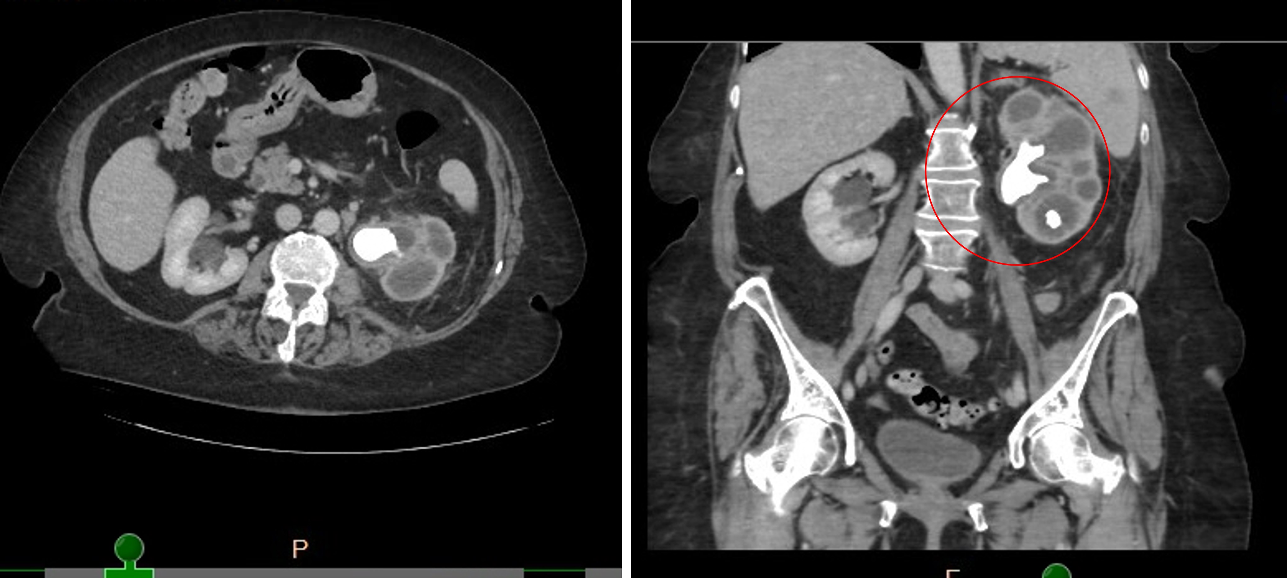 Microscopic image possibly detecting cancerous areas in human tissue