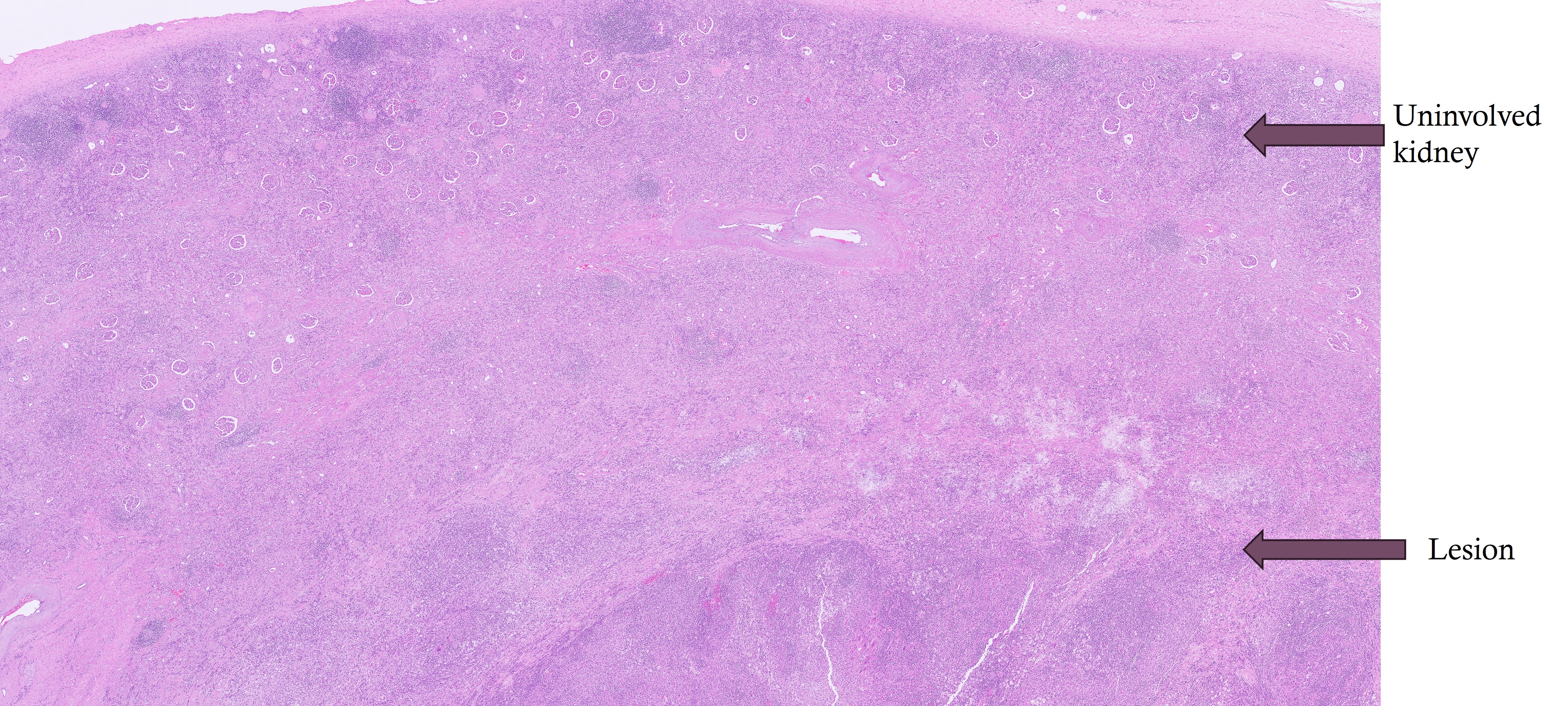 Microscopic image possibly detecting cancerous areas in human tissue