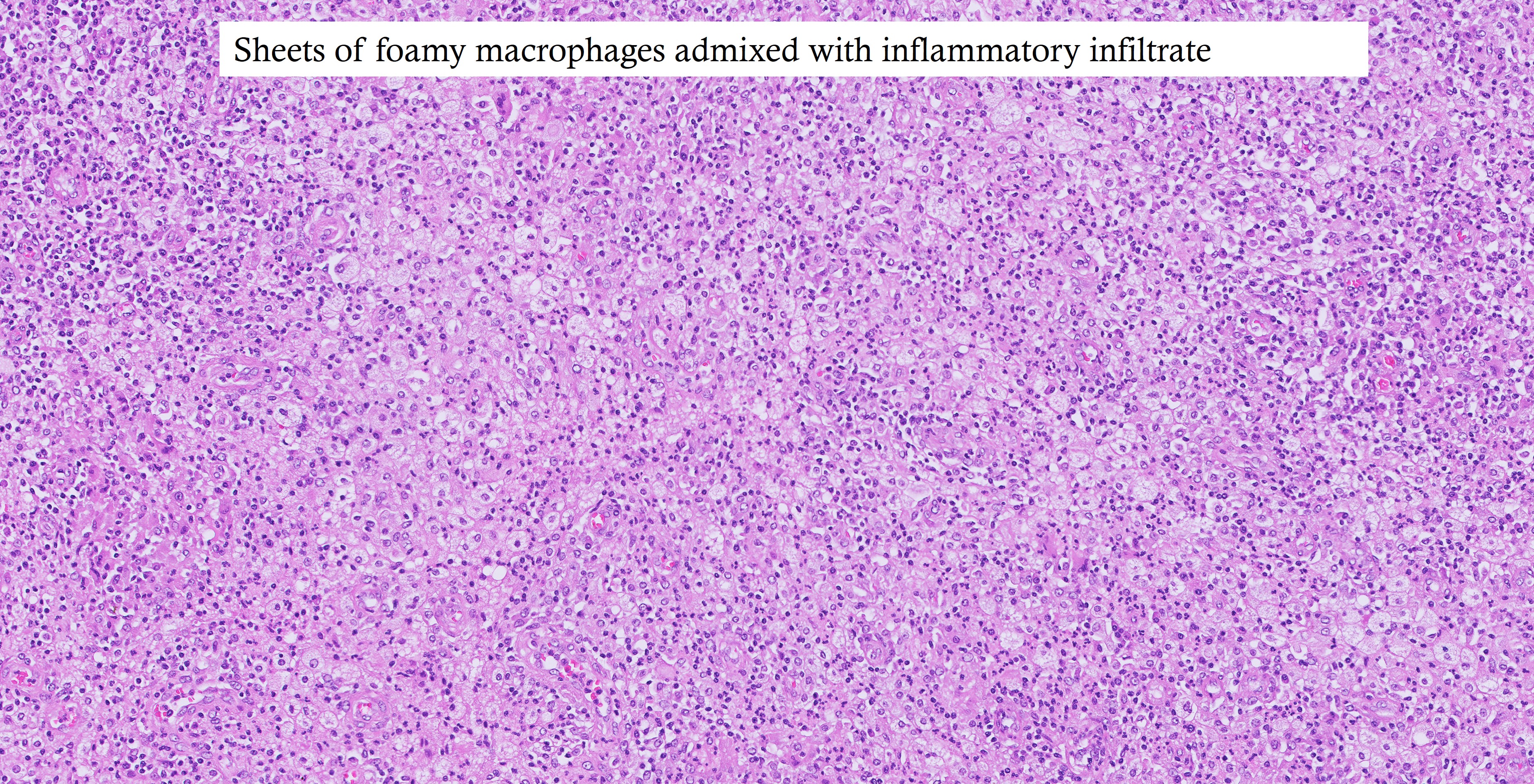 Microscopic image possibly detecting cancerous areas in human tissue