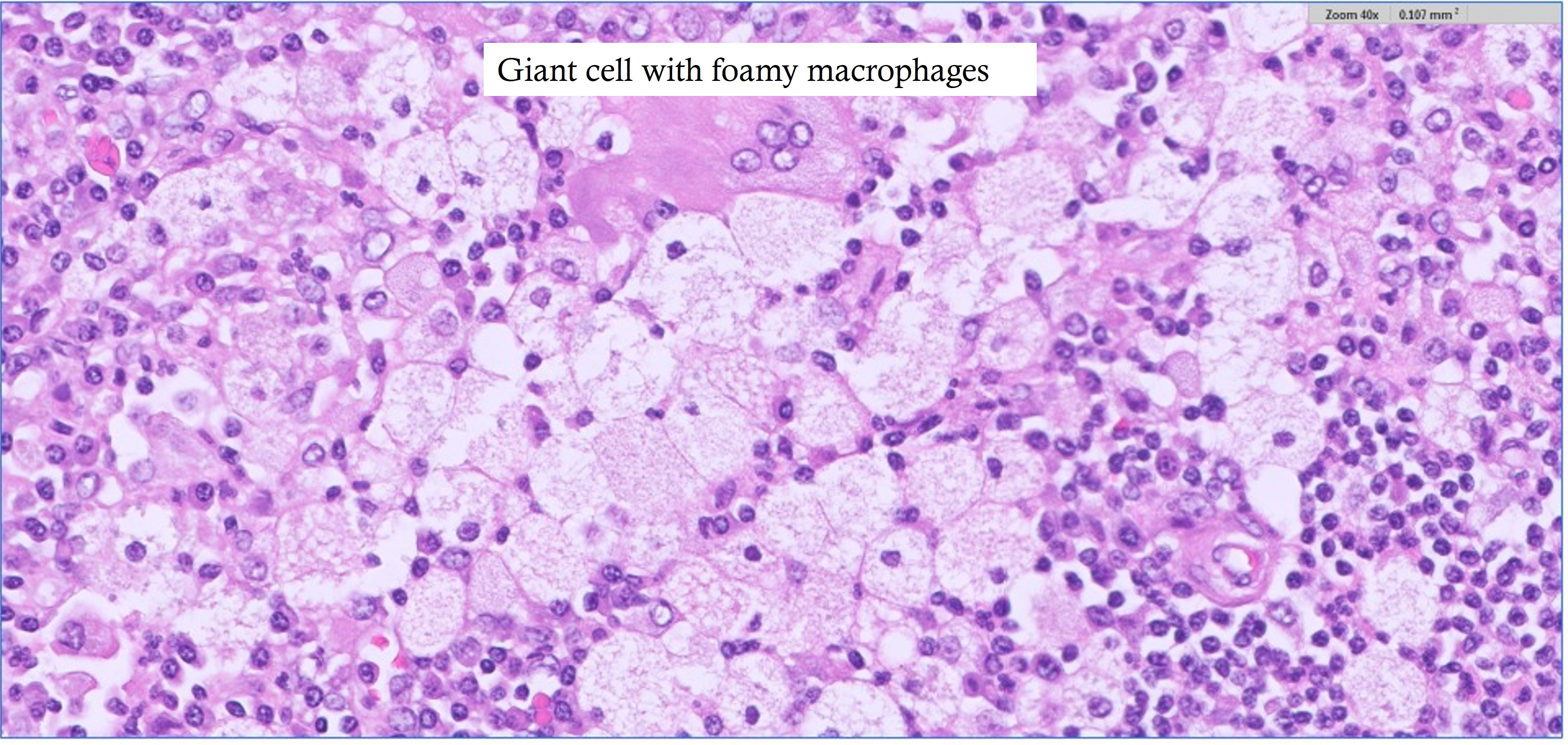 Microscopic image possibly detecting cancerous areas in human tissue