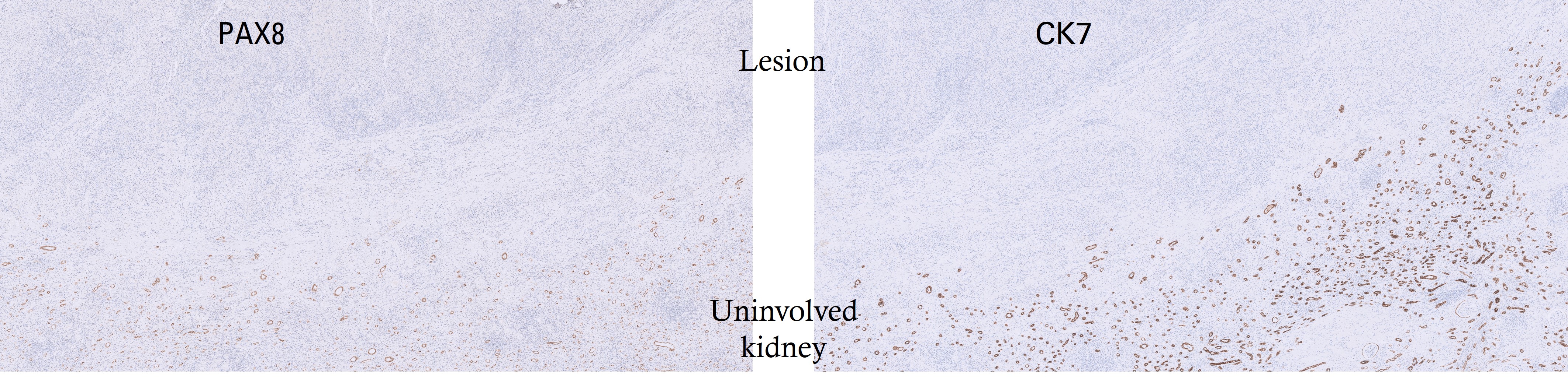 Microscopic image possibly detecting cancerous areas in human tissue