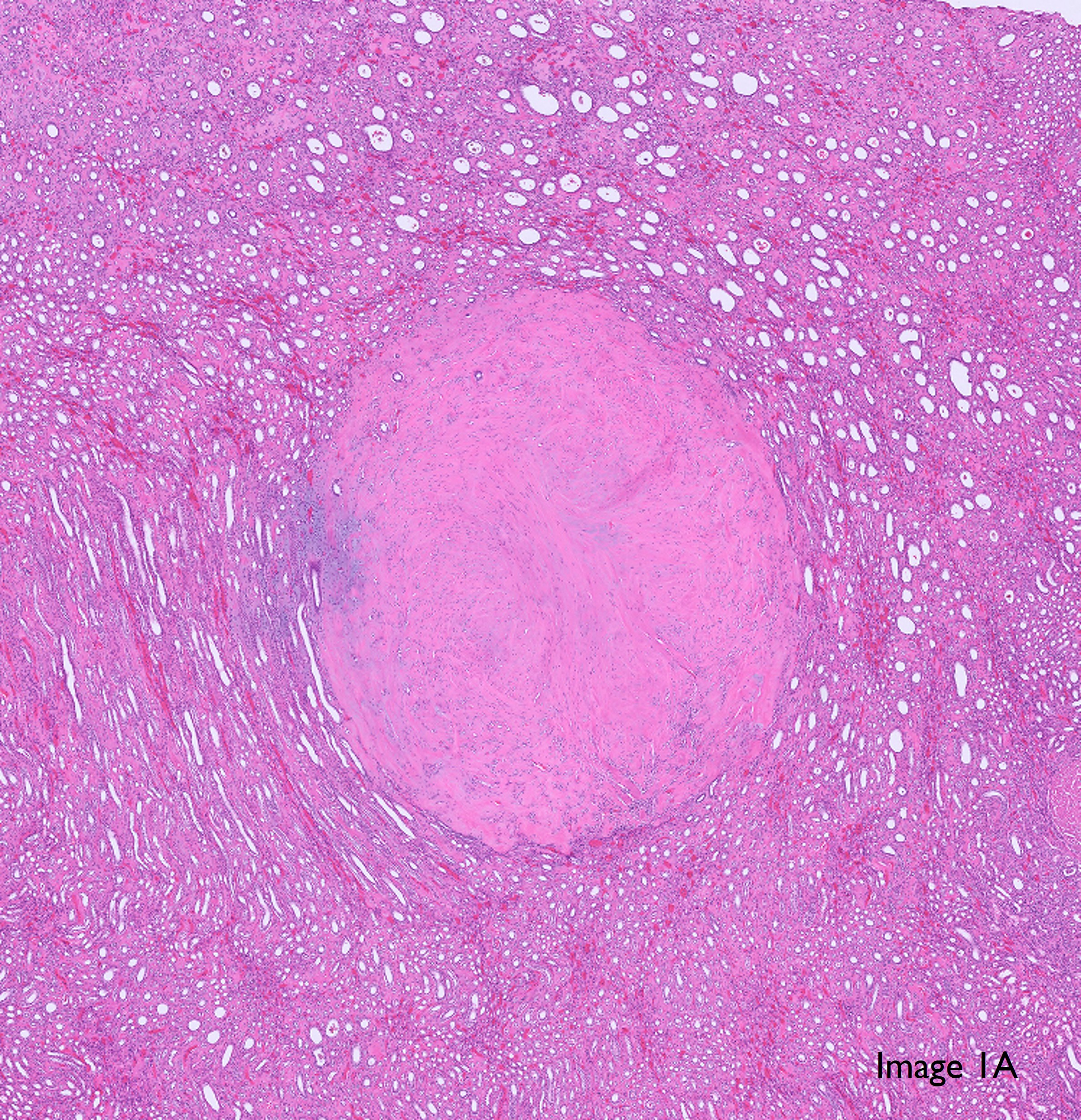 Microscopic image possibly detecting cancerous areas in human tissue