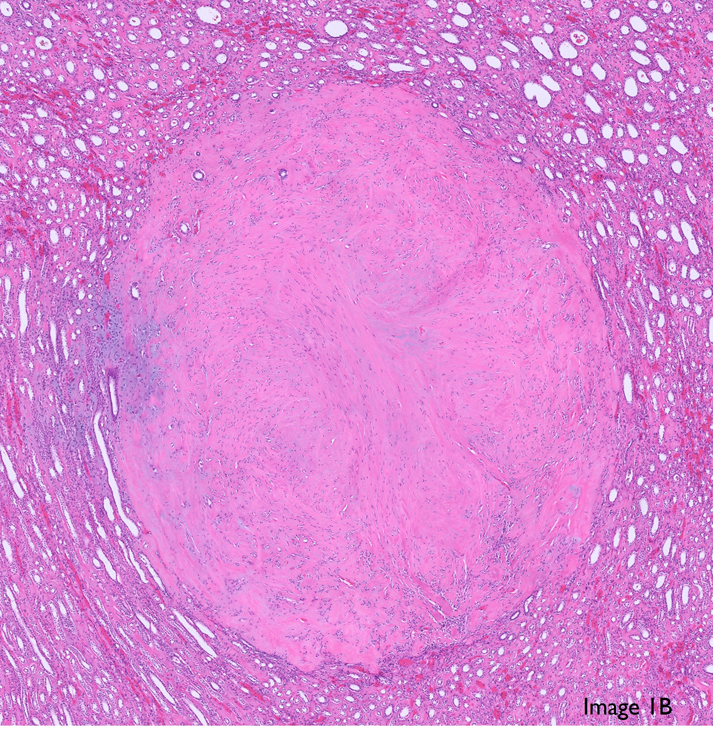 Microscopic image possibly detecting cancerous areas in human tissue