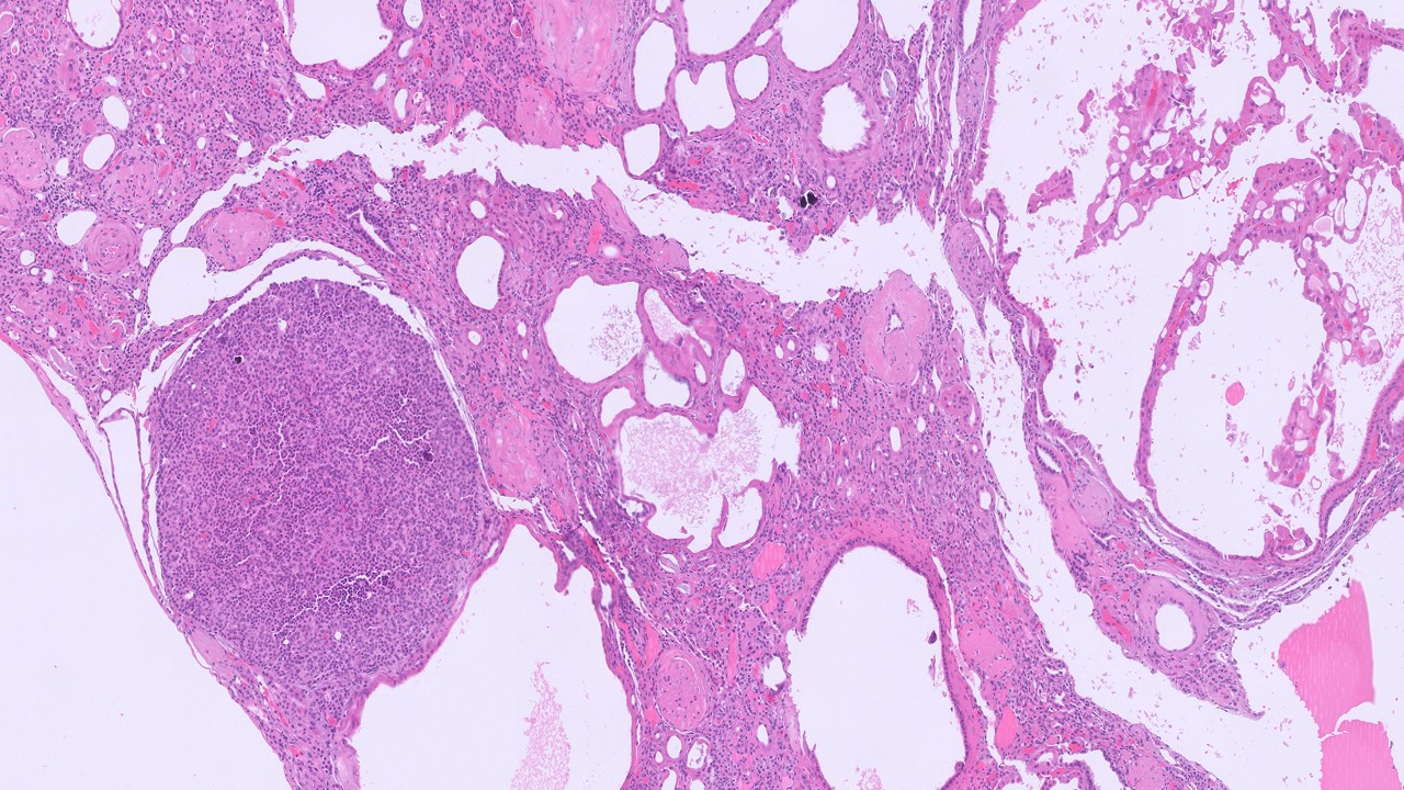 Microscopic image possibly detecting cancerous areas in human tissue