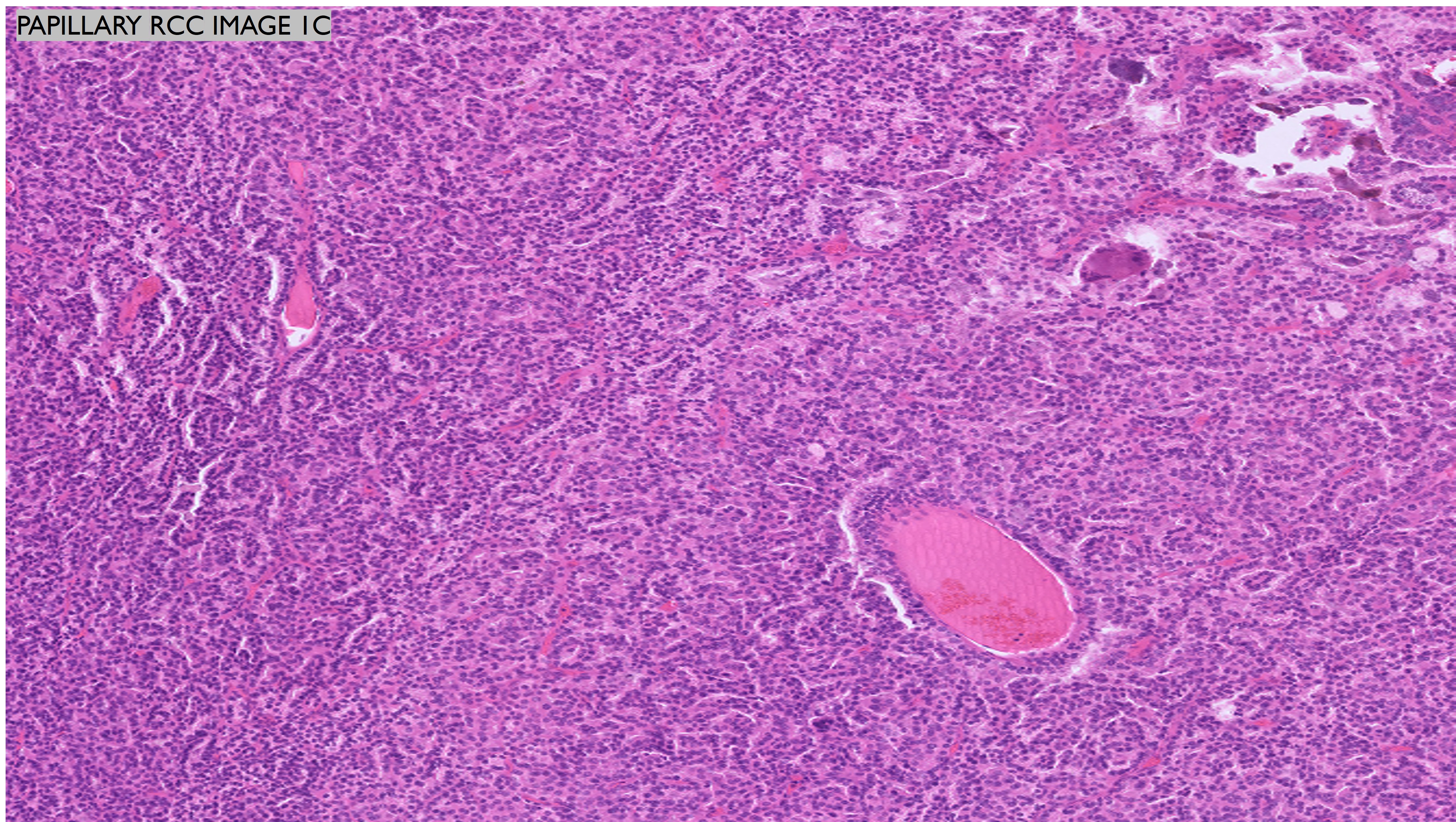 Microscopic image possibly detecting cancerous areas in human tissue