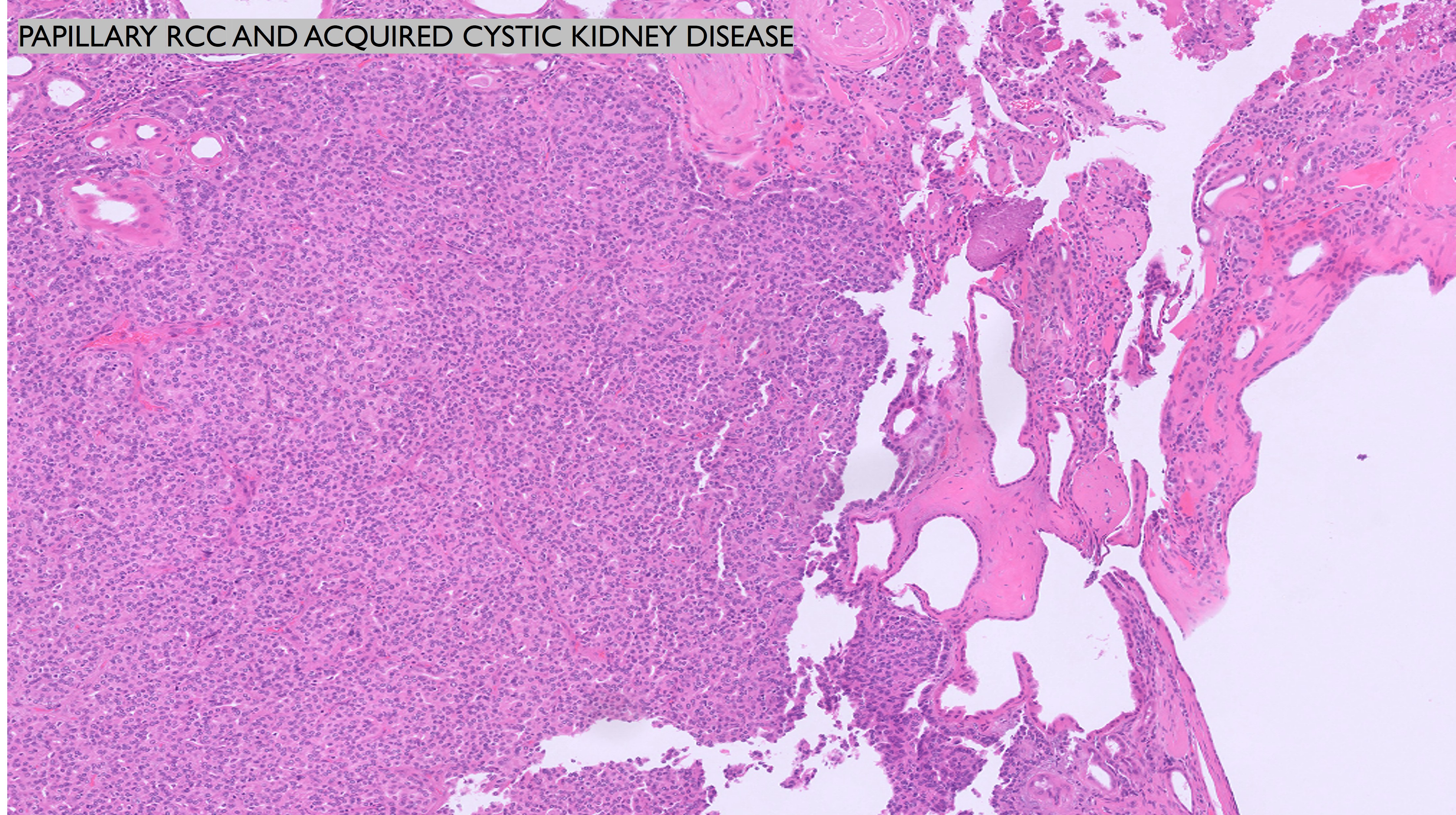 Microscopic image possibly detecting cancerous areas in human tissue