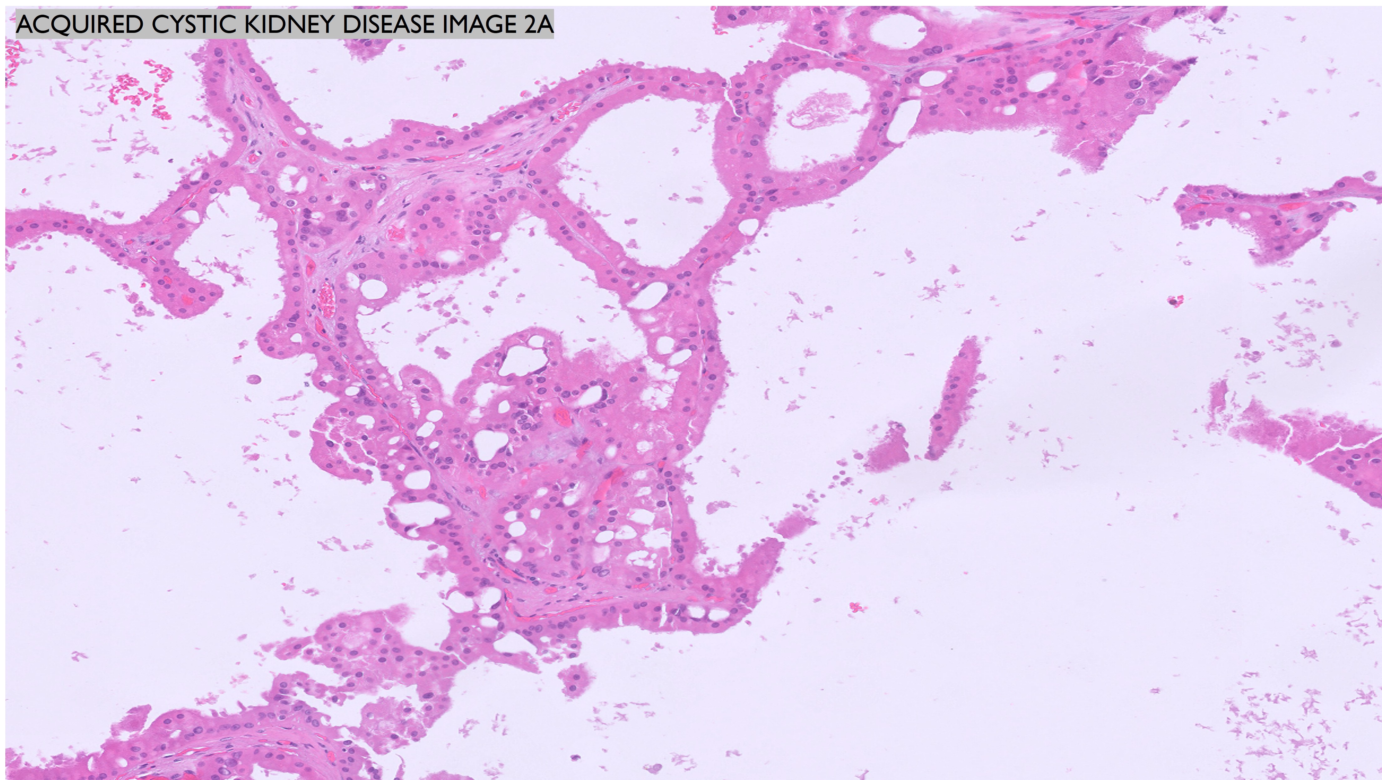 Microscopic image possibly detecting cancerous areas in human tissue