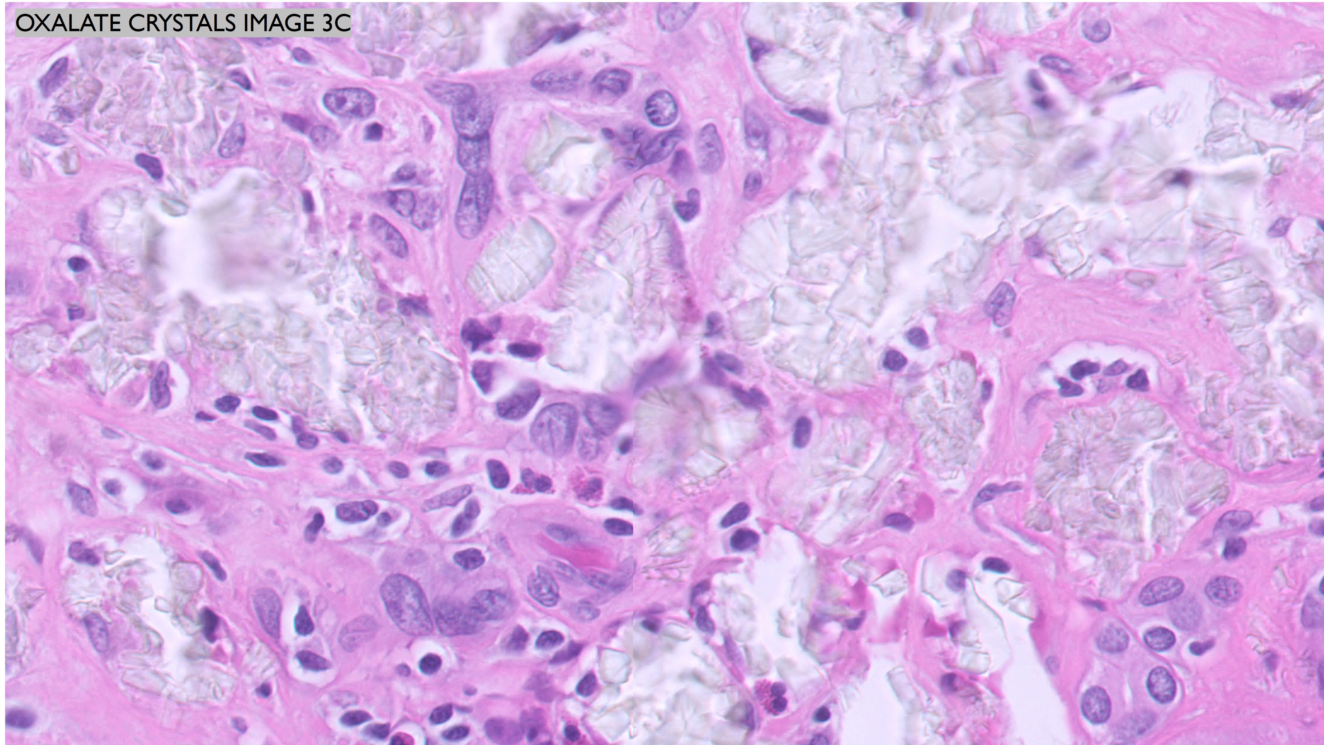 Microscopic image possibly detecting cancerous areas in human tissue