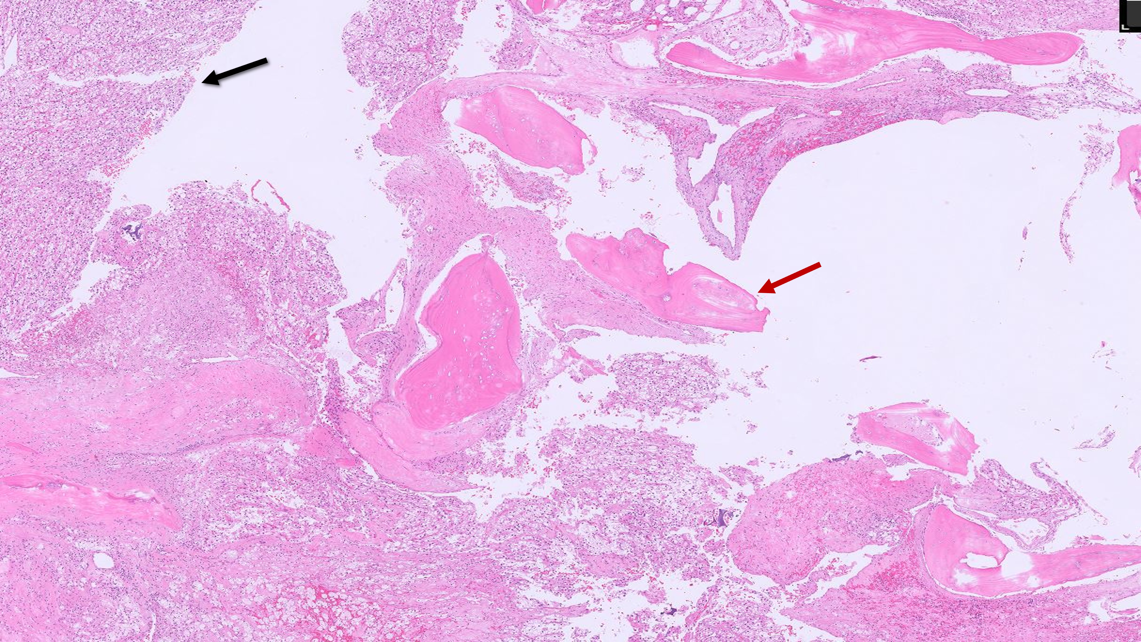 Microscopic image possibly detecting cancerous areas in human tissue