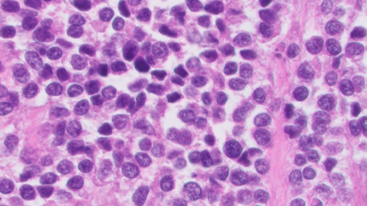 Microscopic image possibly detecting cancerous areas in human tissue
