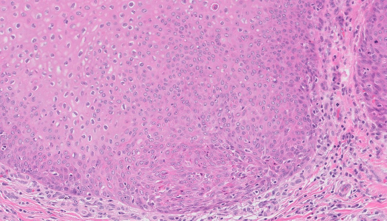 Microscopic image possibly detecting cancerous areas in human tissue
