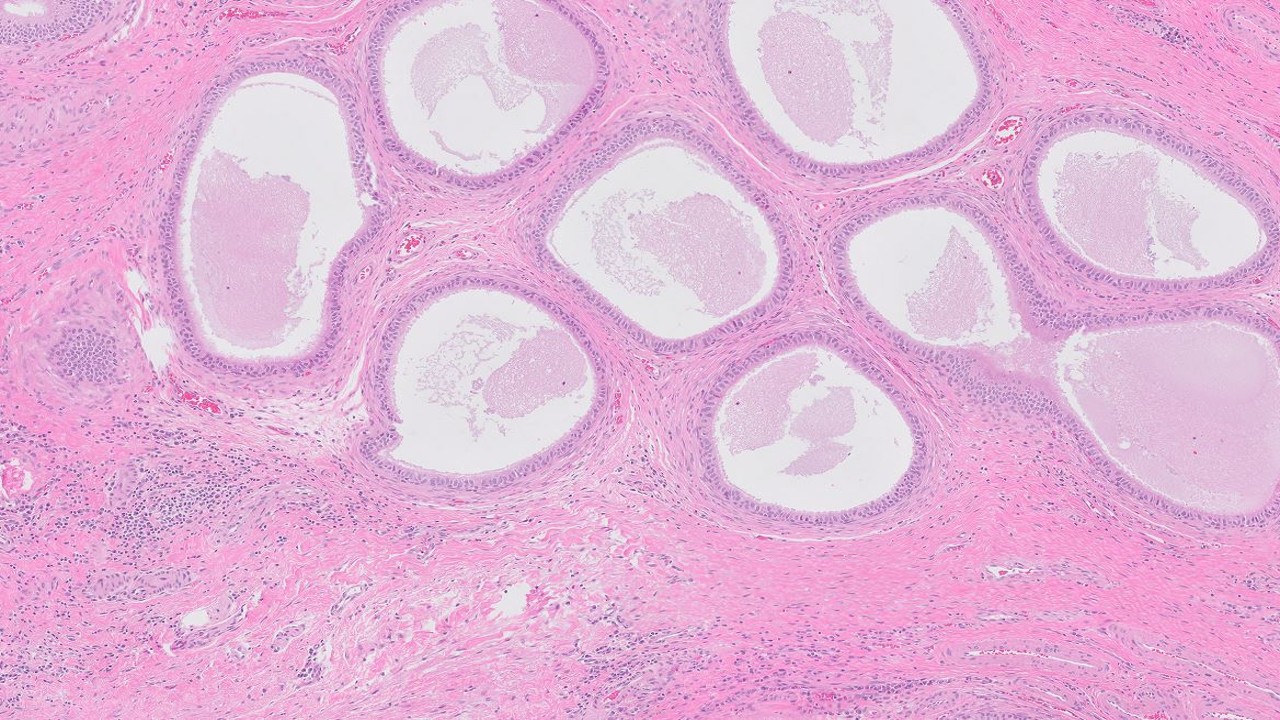 Microscopic image possibly detecting cancerous areas in human tissue