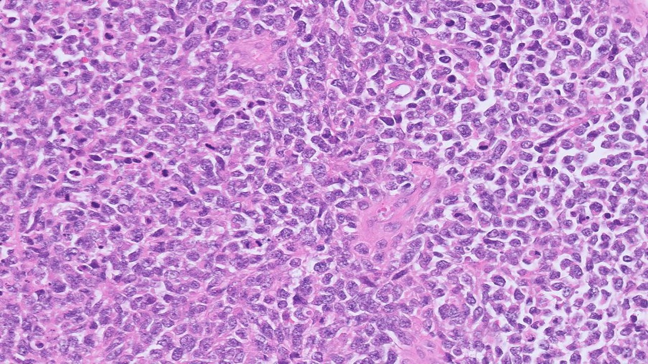 Microscopic image possibly detecting cancerous areas in human tissue