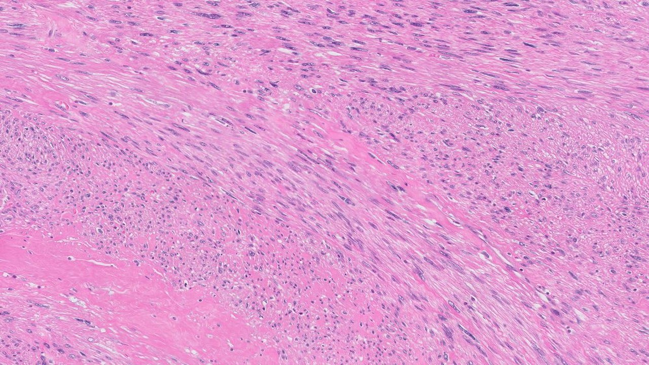 Microscopic image possibly detecting cancerous areas in human tissue
