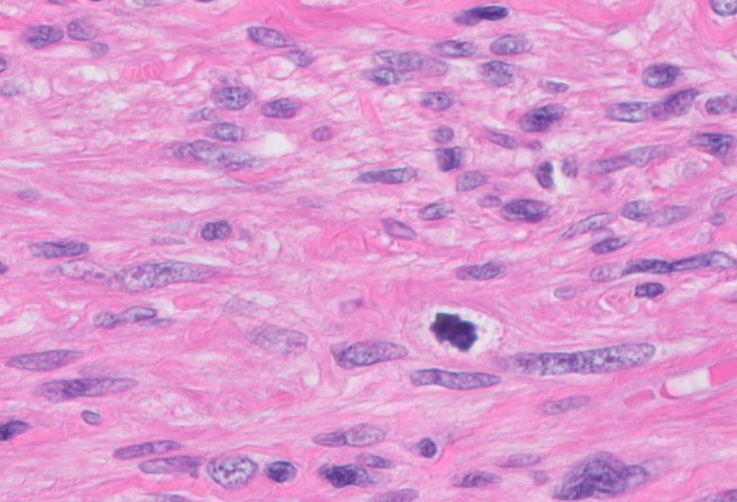 Microscopic image possibly detecting cancerous areas in human tissue
