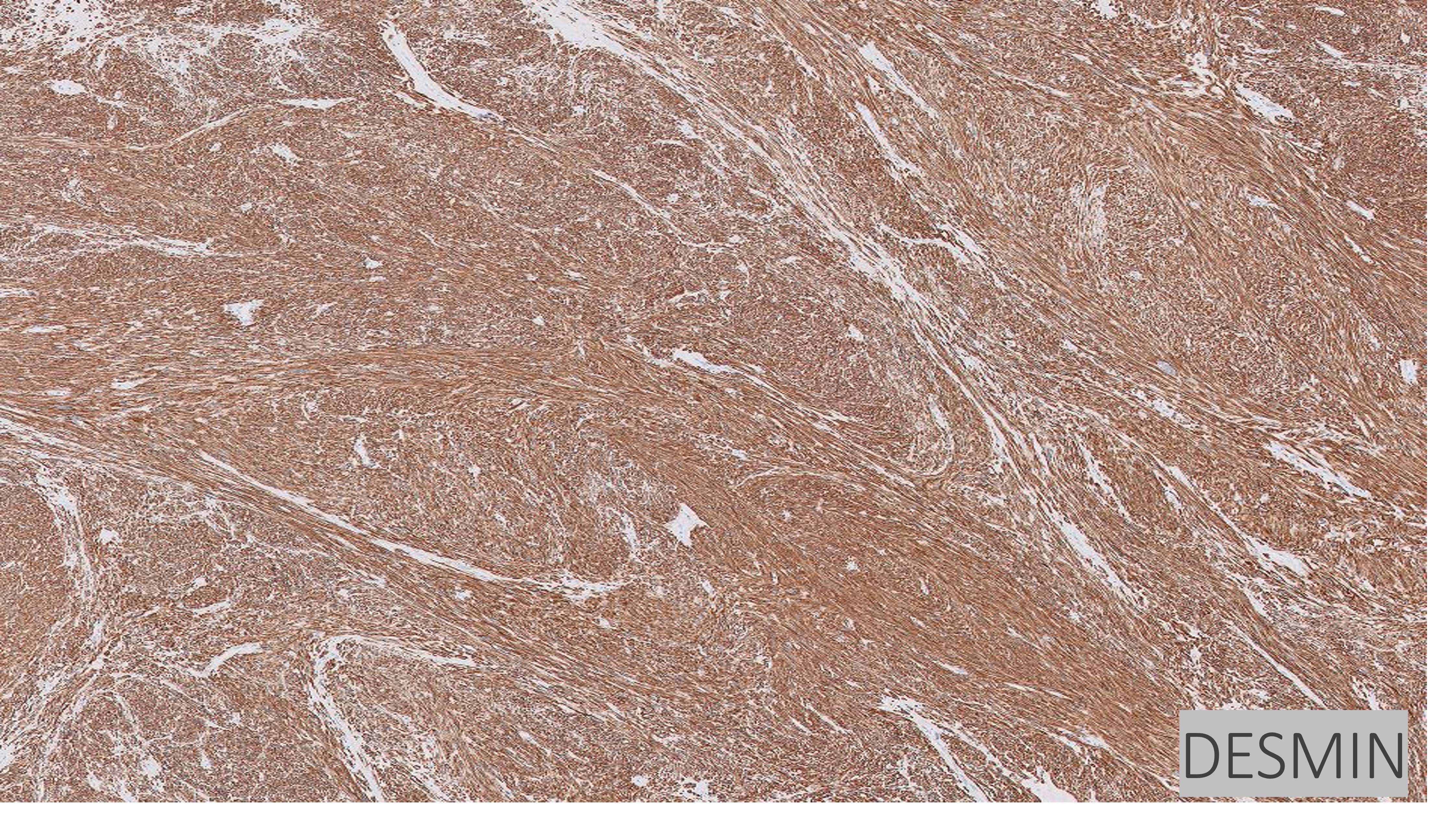 Microscopic image possibly detecting cancerous areas in human tissue