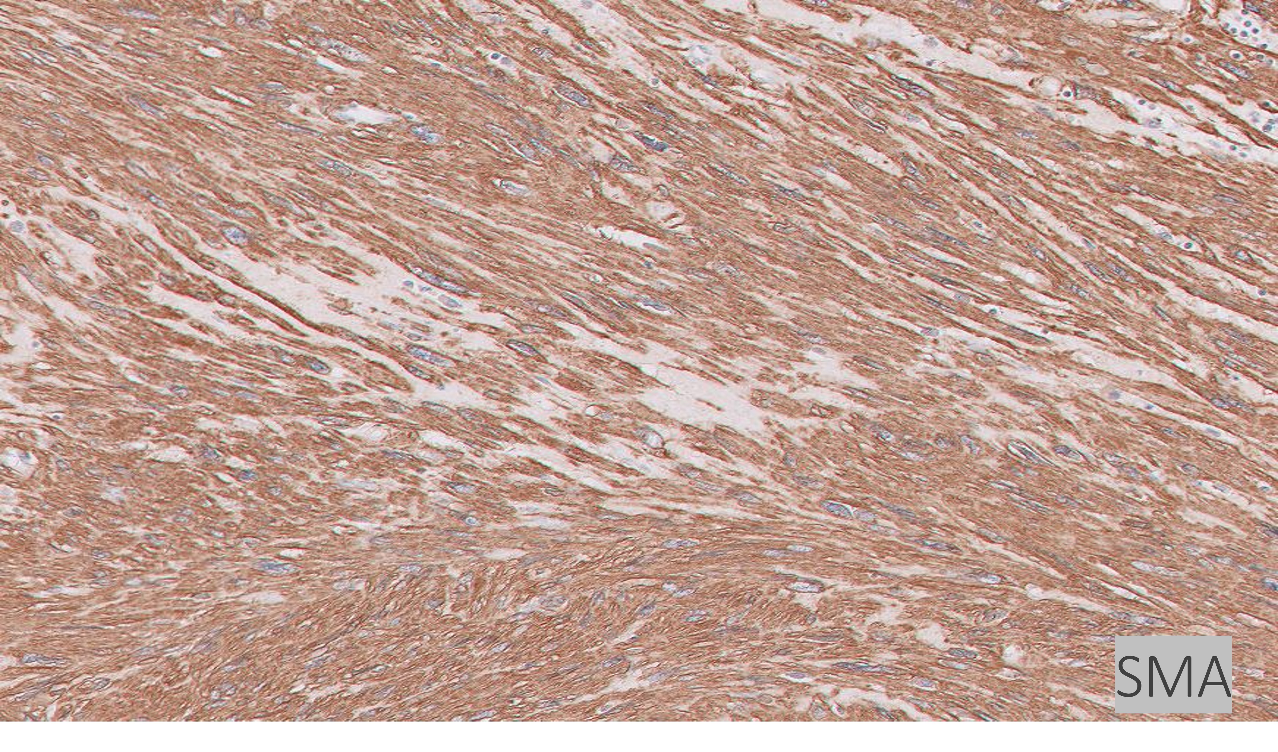 Microscopic image possibly detecting cancerous areas in human tissue
