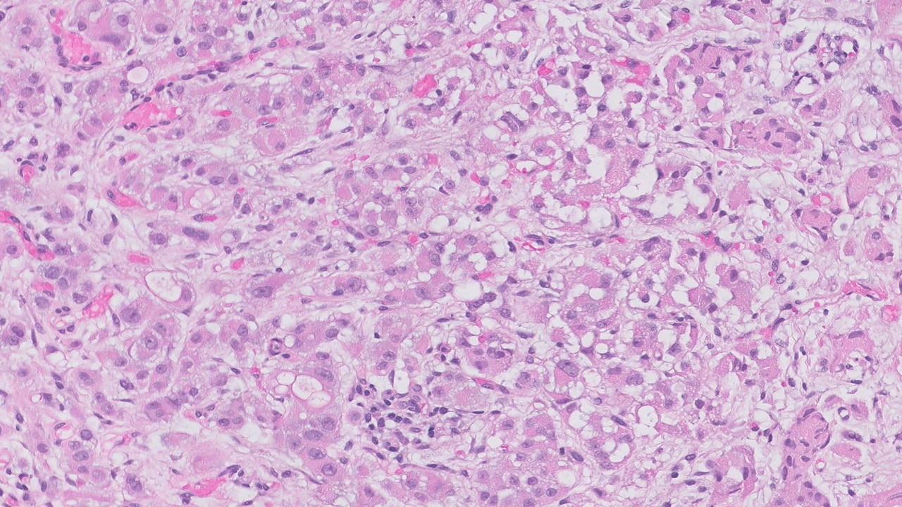 Microscopic image possibly detecting cancerous areas in human tissue