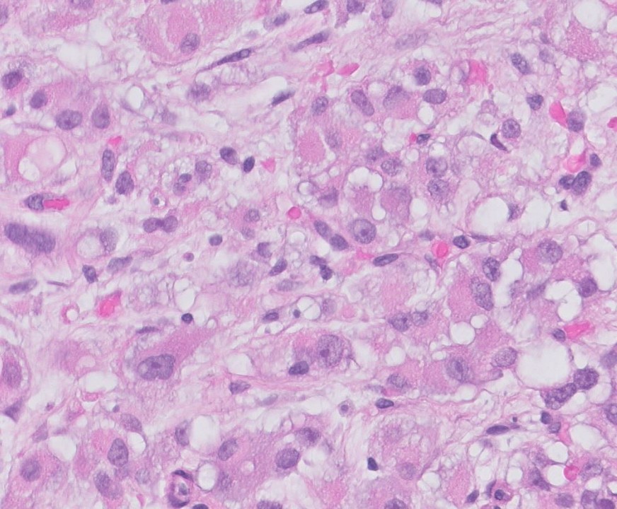Microscopic image possibly detecting cancerous areas in human tissue