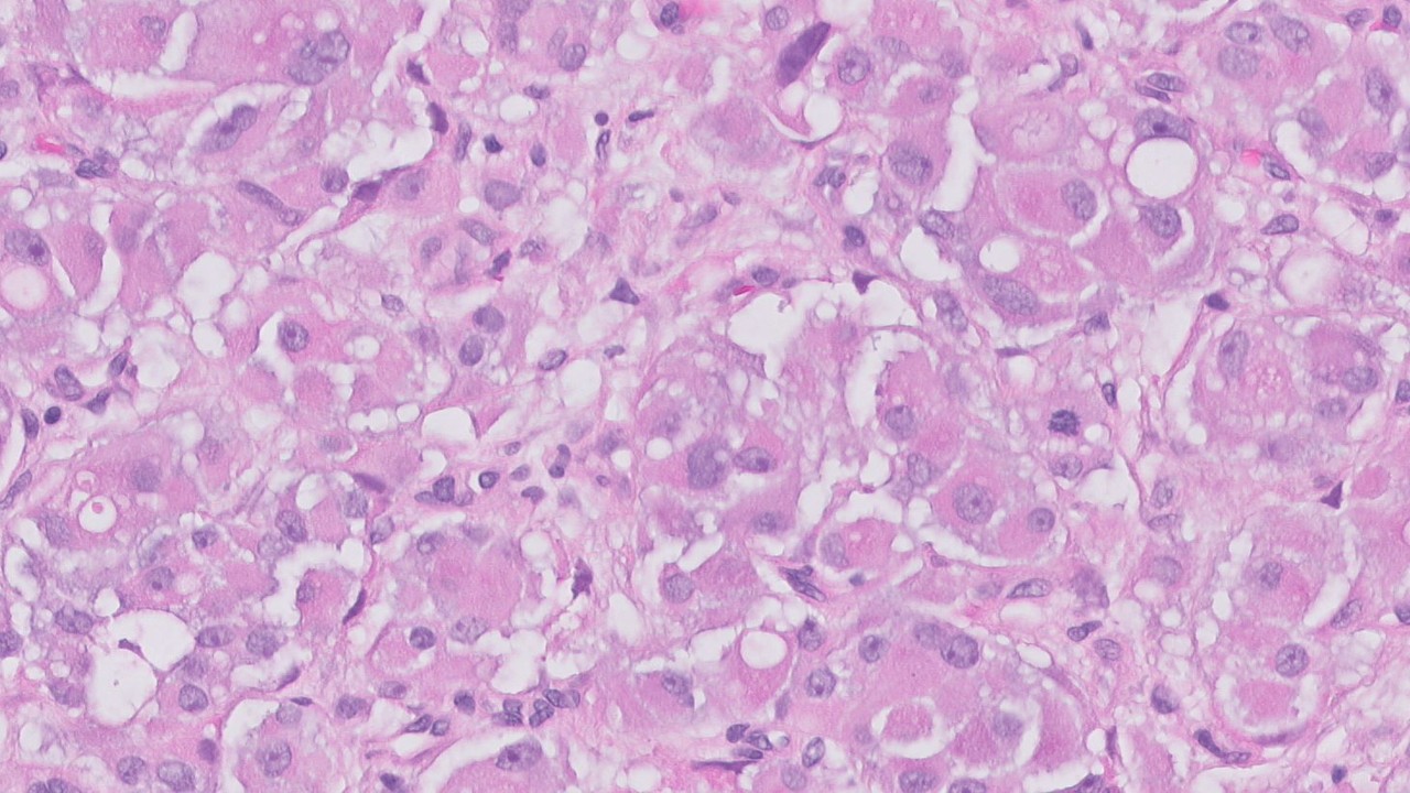 Microscopic image possibly detecting cancerous areas in human tissue
