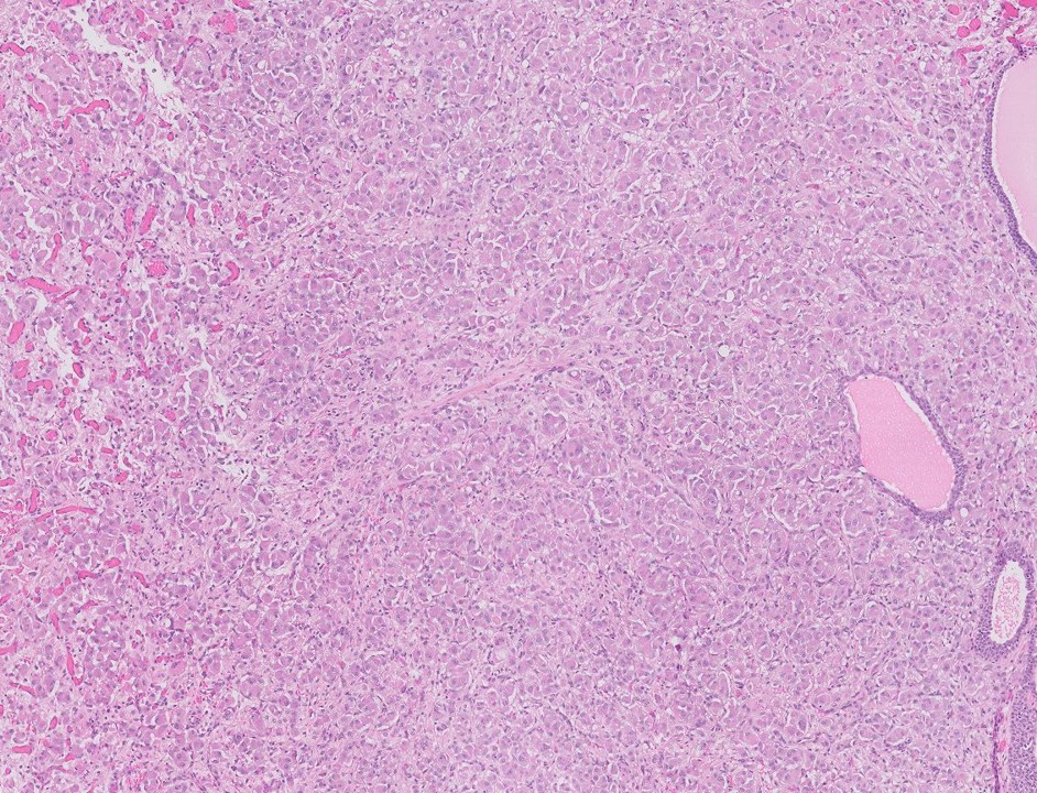 Microscopic image possibly detecting cancerous areas in human tissue