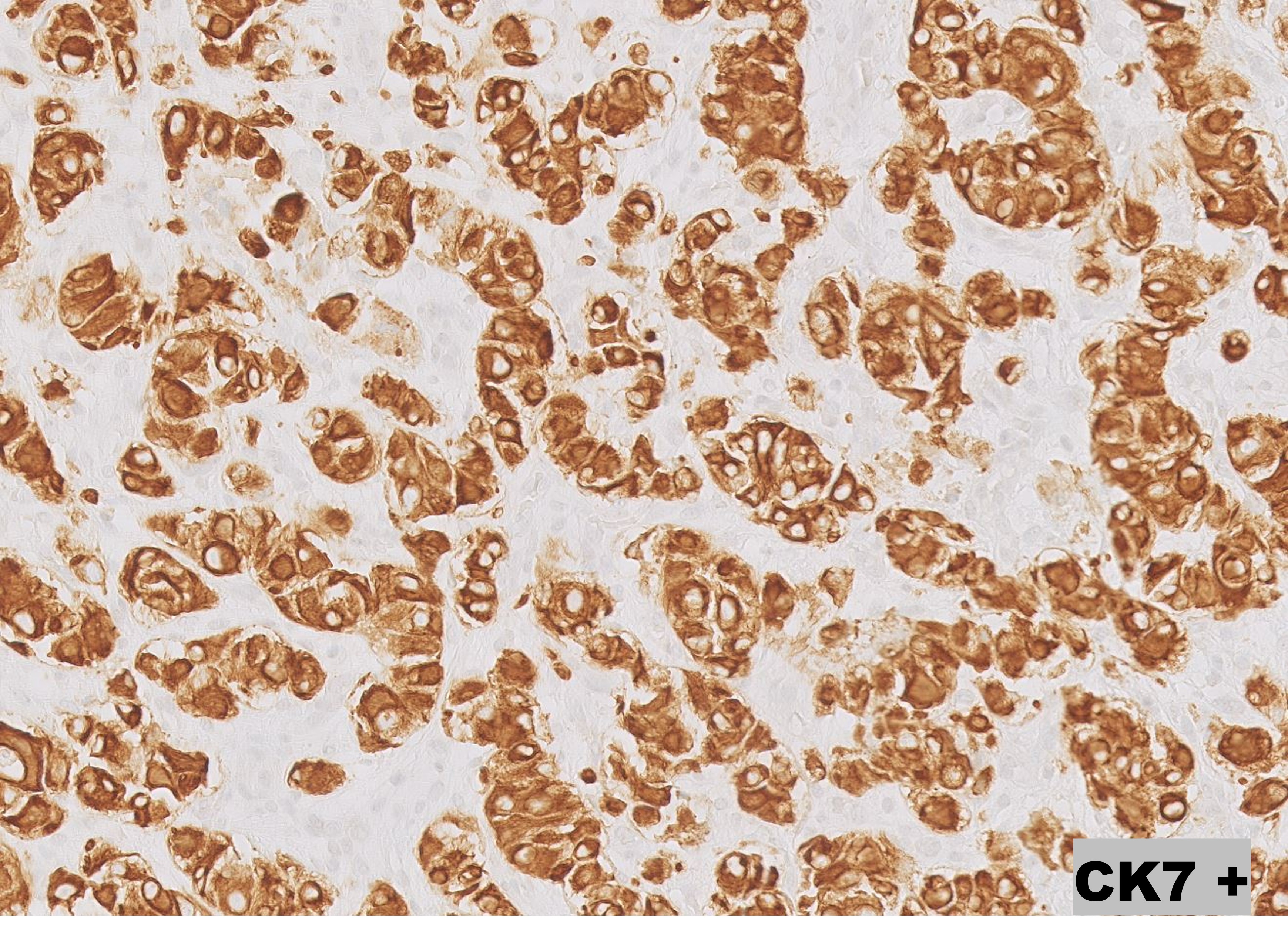 Microscopic image possibly detecting cancerous areas in human tissue