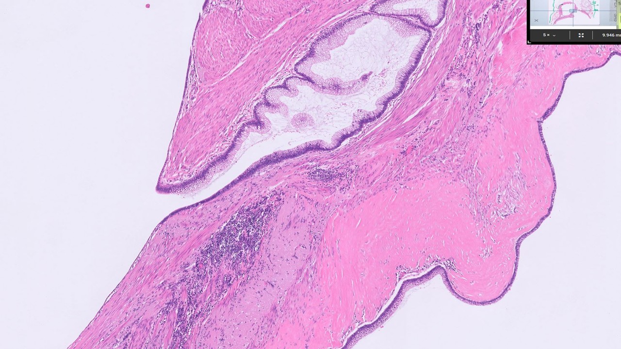 Microscopic image possibly detecting cancerous areas in human tissue