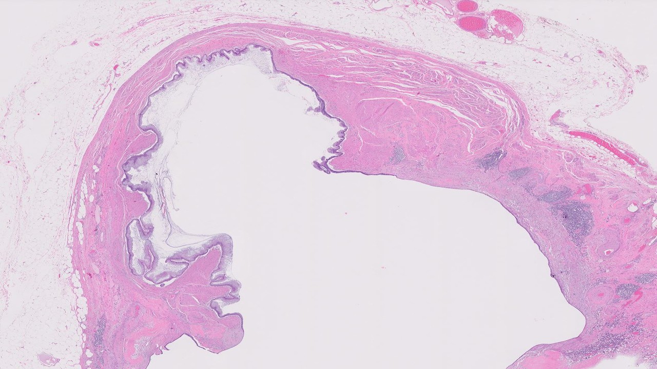 Microscopic image possibly detecting cancerous areas in human tissue