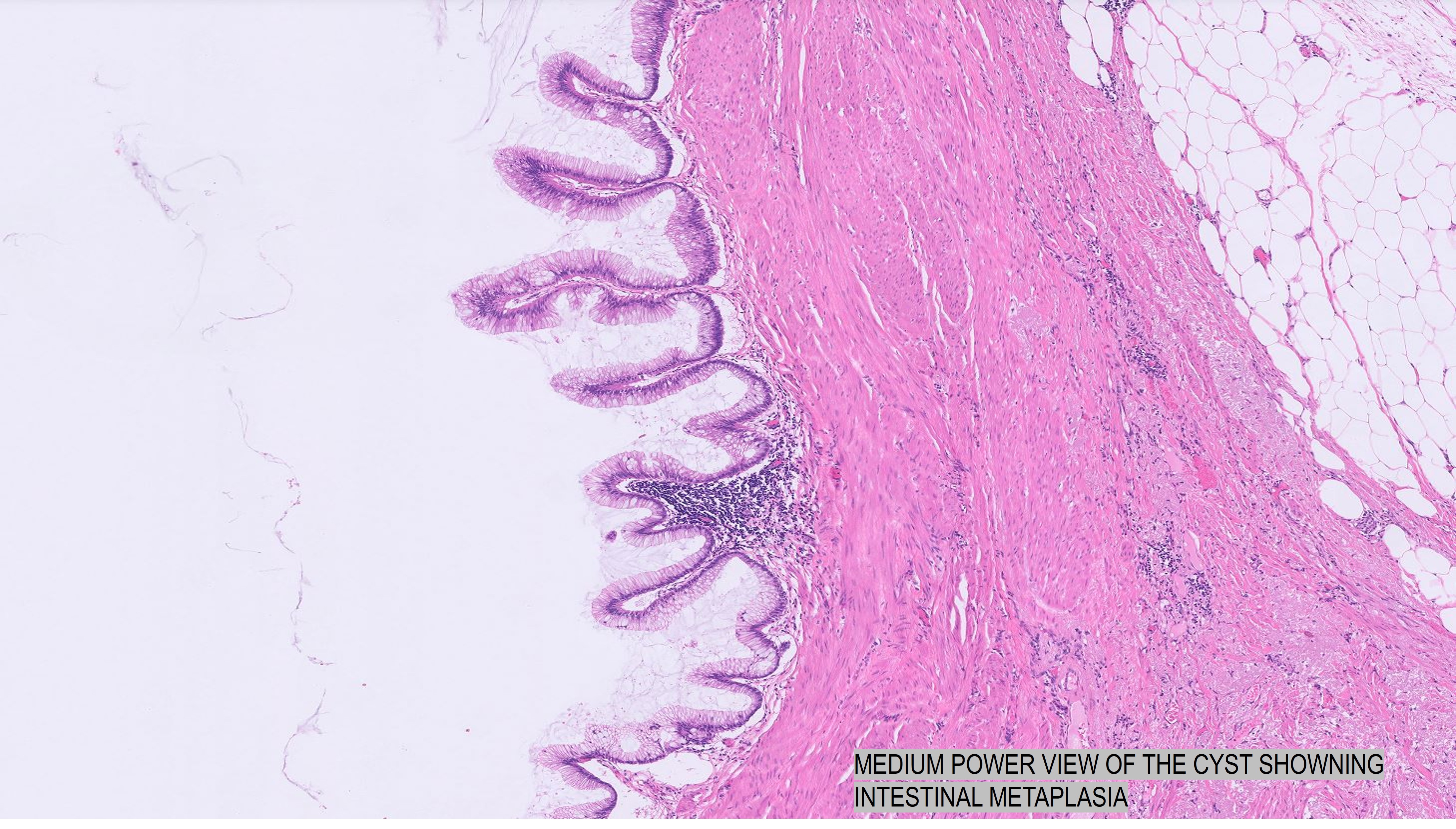 Microscopic image possibly detecting cancerous areas in human tissue