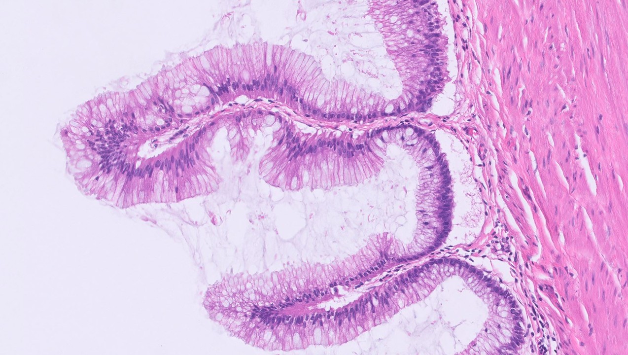 Microscopic image possibly detecting cancerous areas in human tissue