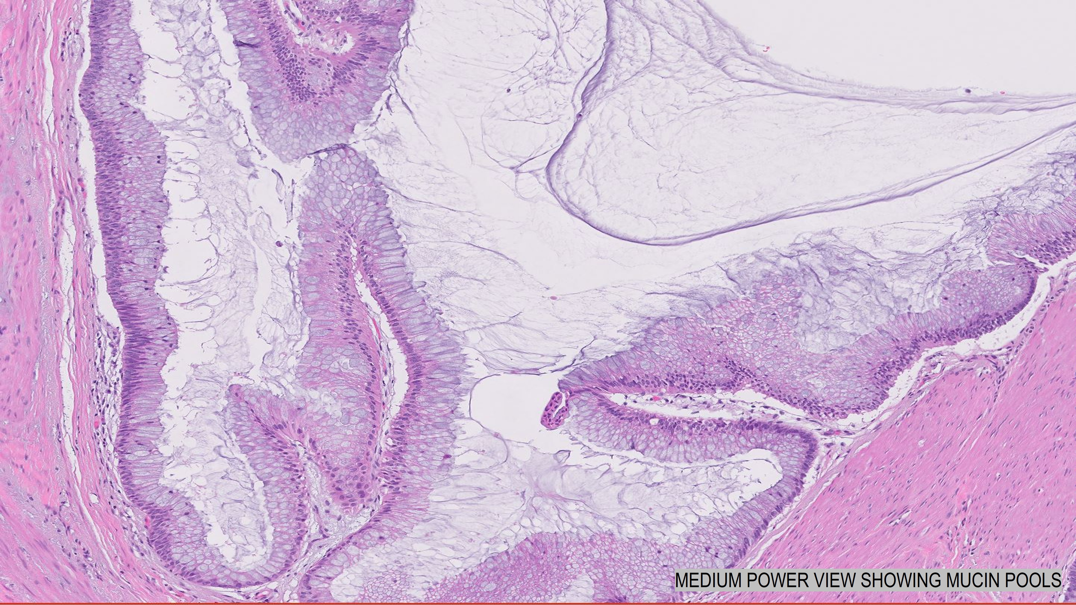 Microscopic image possibly detecting cancerous areas in human tissue