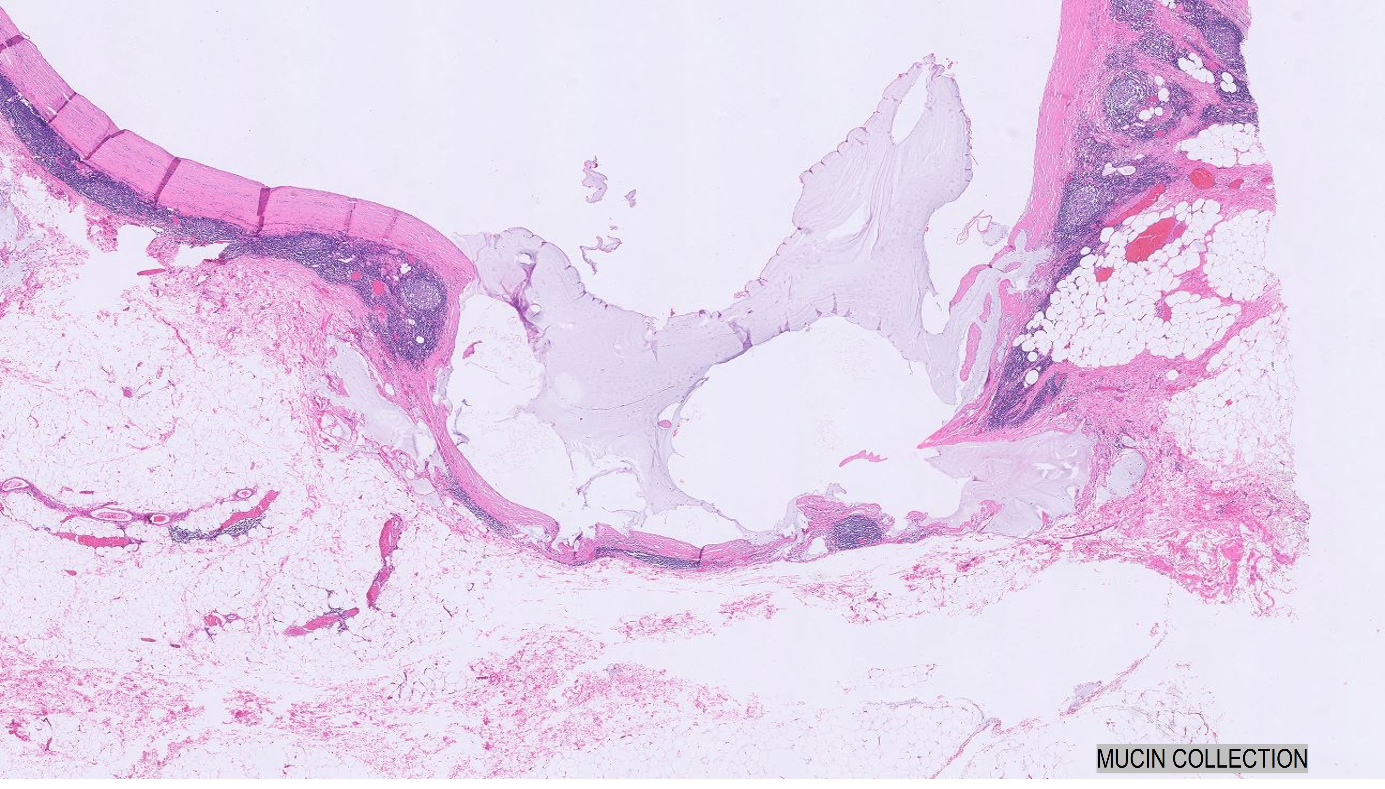 Microscopic image possibly detecting cancerous areas in human tissue